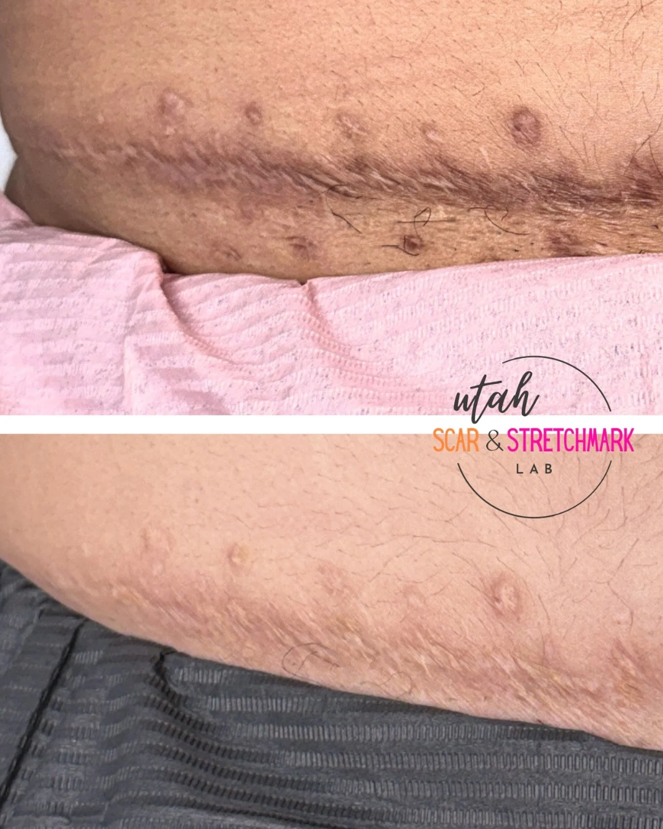 After 1 session of camouflage tattoo for dark scars.  Since this scar is over 18 months old, I decided to go with color neutralizing using colors ⚪️+🟡
There were a few areas that were oversaturated with ink, so in session 2, we did some saline remov