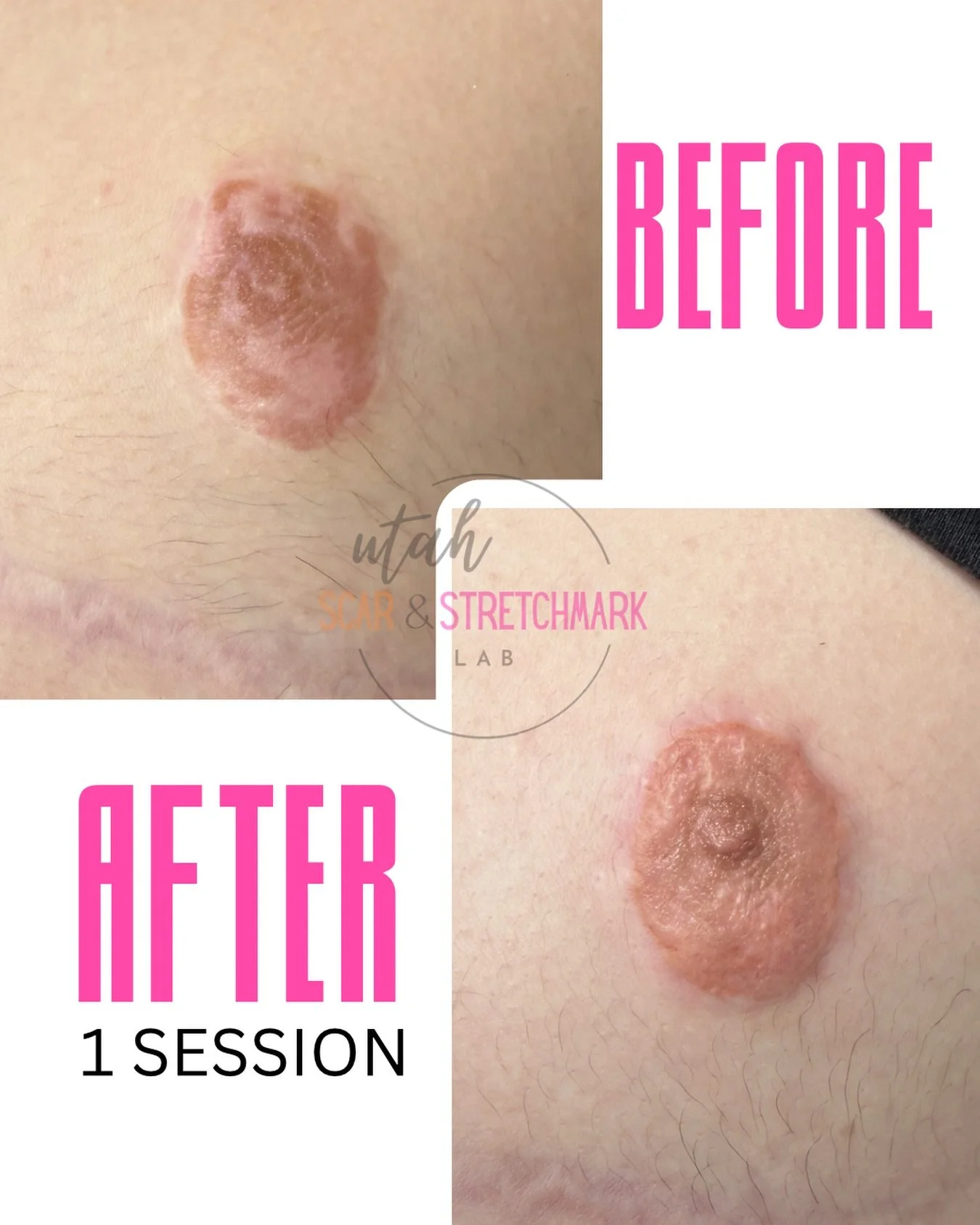 A medical tattoo is the only way to bring pigment back to an area that has lost all its color.  This is a client who had a mastectomy that left them with uneven color.  This is immediately after the first session.  I estimate we will need 1-2 more se