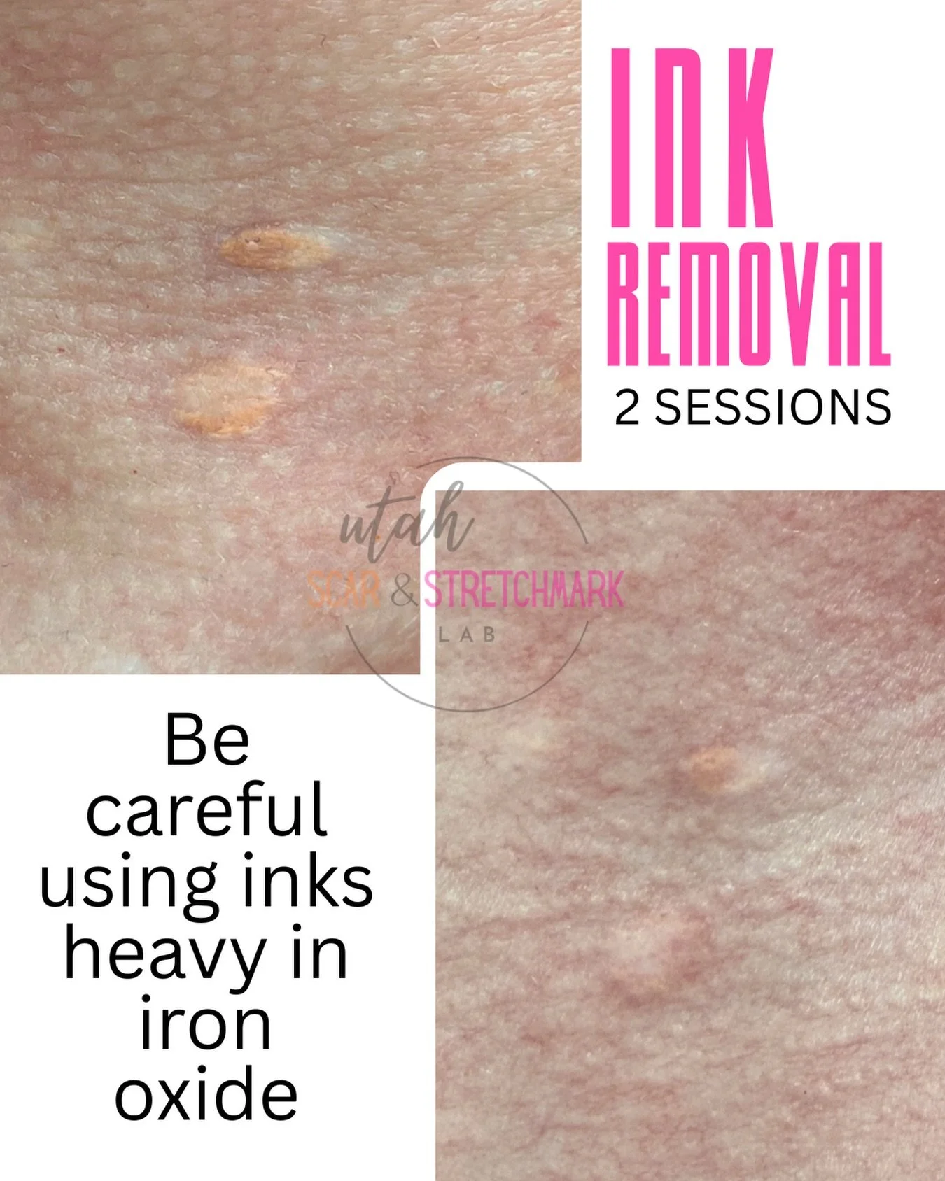 SALINE INK LIGHTENING &bull; 2 SESSIONS ✨

This client came to us after seeing an out-of-state artist who claimed extensive experience&mdash;but over time, the ink told a different story.

That orange/yellow shift? Oxidation.

Many cosmetic tattoo in