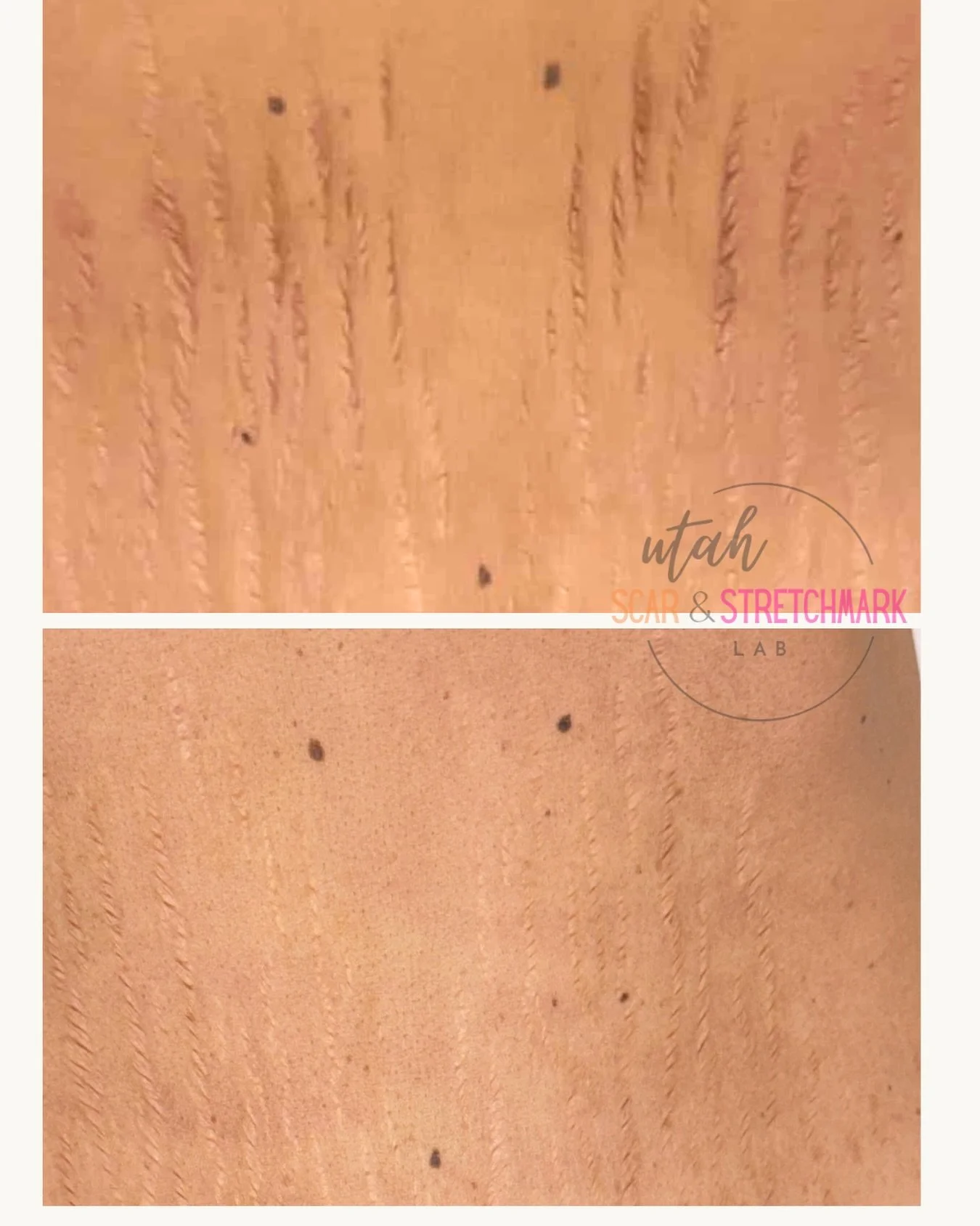 7 sessions over the span of 4 years.  This client knows who she is. Thanks for being patient with me girl! Can't wait to see you again. ❤️
#paramedicaltattoo #stretchmarksbegone #stretchmarks