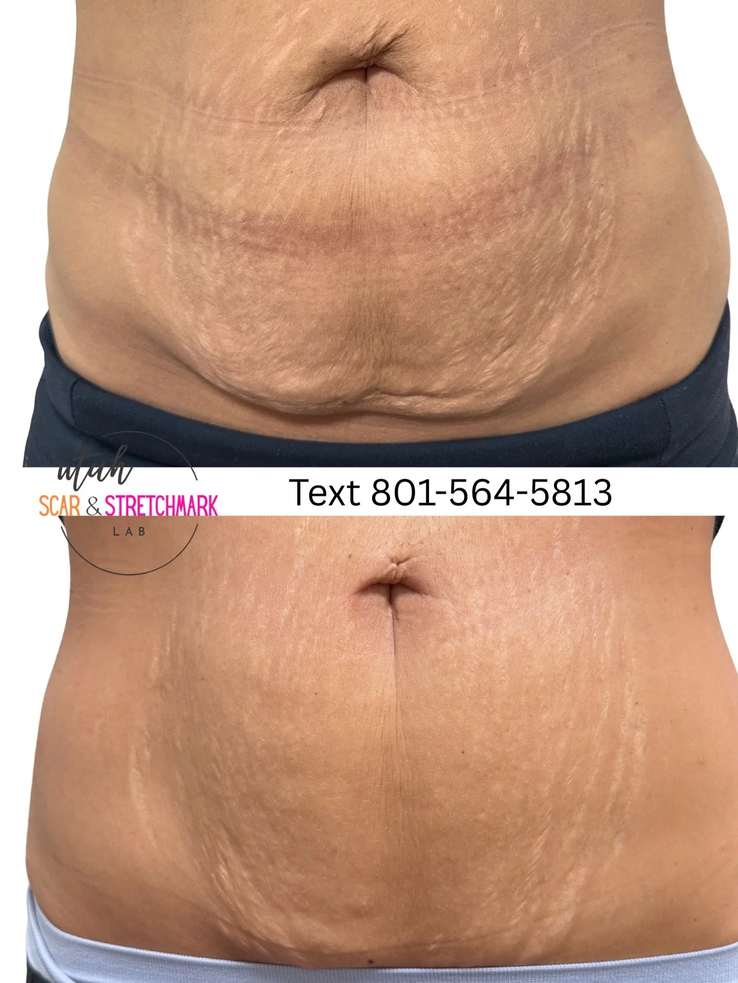 After just one session!  Did you know tattoo needles are also phenomenal at resurfacing loose skin?  A camouflage tattoo has two benefits in one. Tinting the stretch mark as well as tightening the skin. ❤️
#stretchmarksbegone #stretchmarkcamouflage #