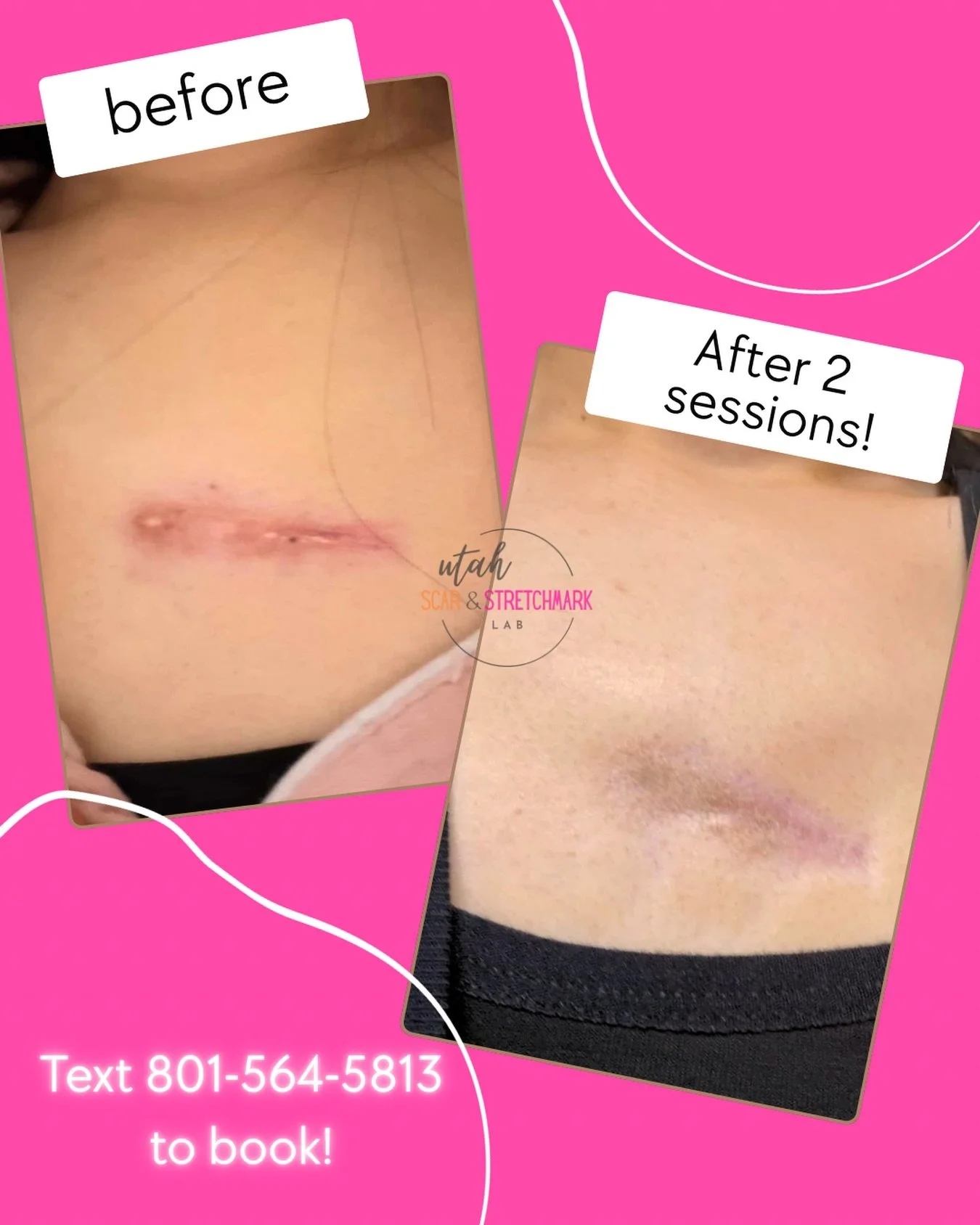 After 2 sessions, this scar is 75% camouflaged!  I love it when my clients trust the process.  After having the scar for 5+ years she was ready for it to be gone. 

Ideal candidate for scar camouflage tattoo: 
- Scar is at least one year old 
- You w