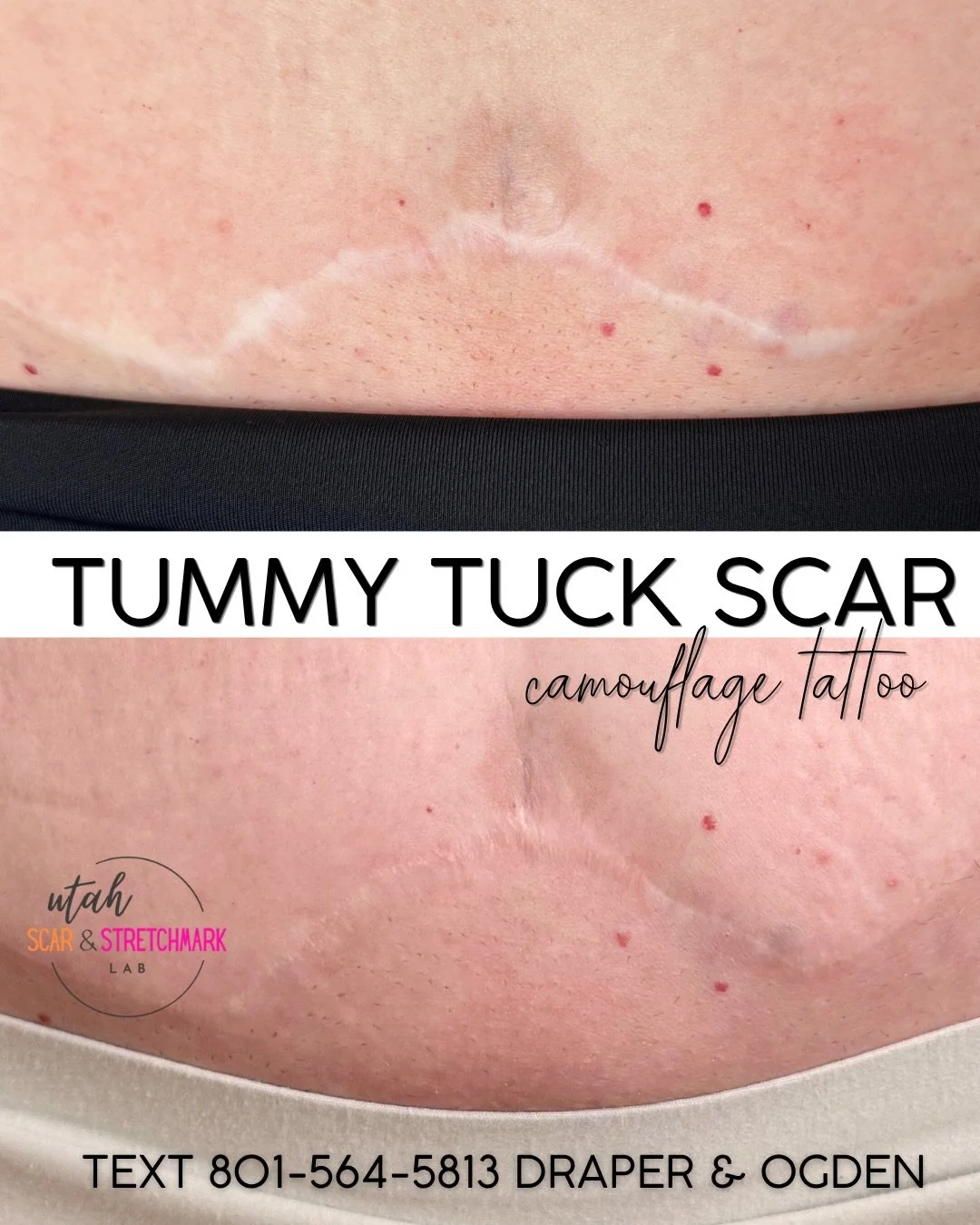 Medical Tattooing is now in Draper &amp; Ogden, Utah ✨

✔ Scar Camouflage 
✔ Stretch Mark Camouflage 
✔ Hair Loss Solutions 

You don&rsquo;t have to keep covering up the reminders of surgery, pregnancy, injury, or trauma. Advanced medical tattooing 