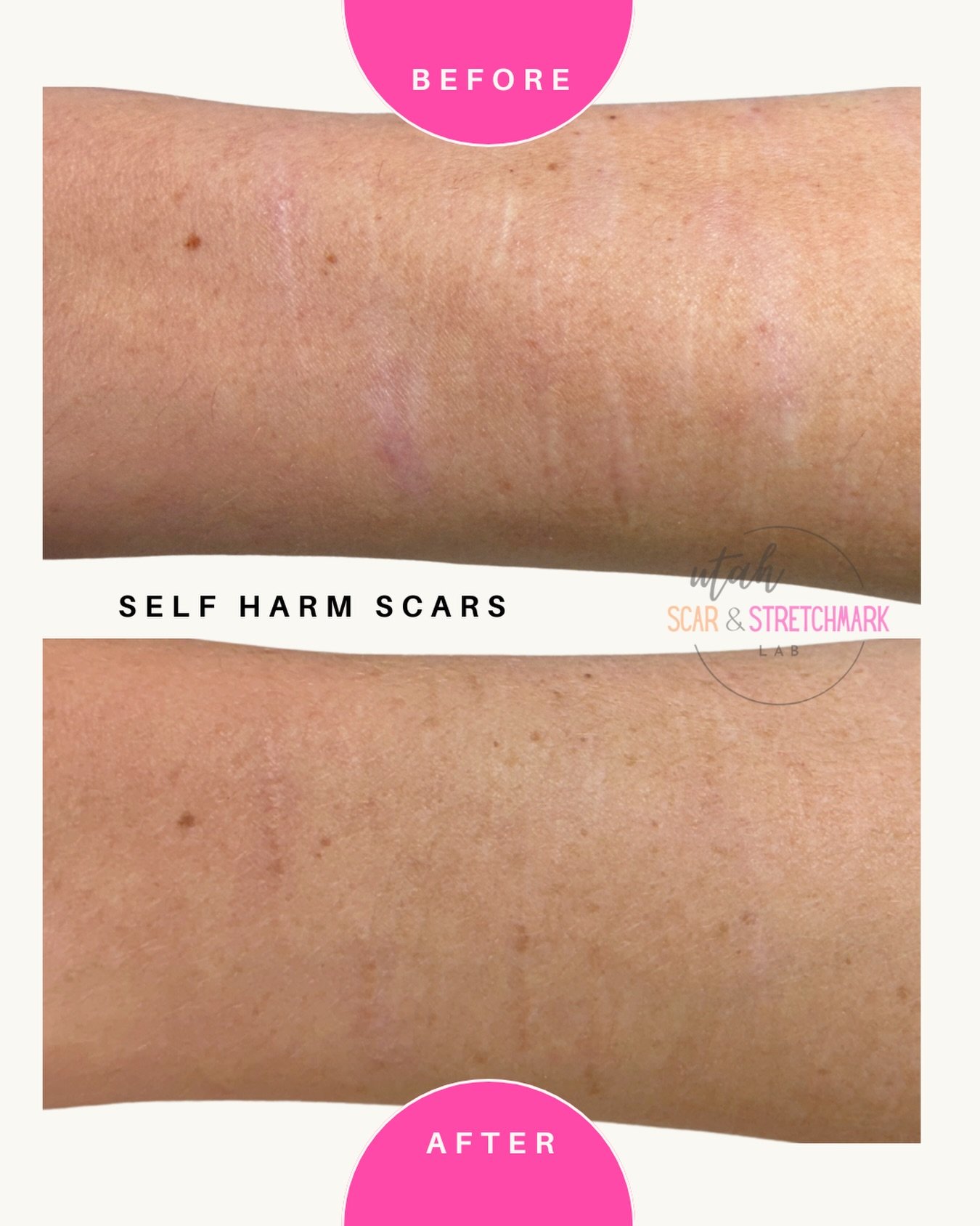 Self harm scars after just one session! #camouflagetattoo #scartattoo #recovery