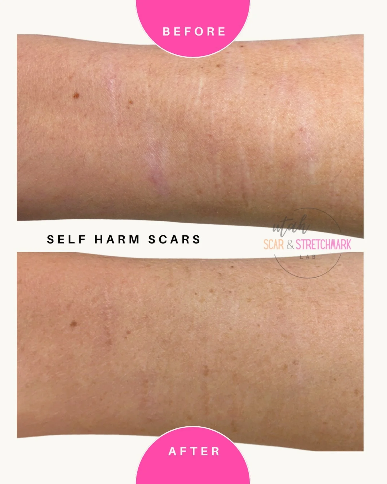 Self harm scars after just one session! #camouflagetattoo #scartattoo #recovery