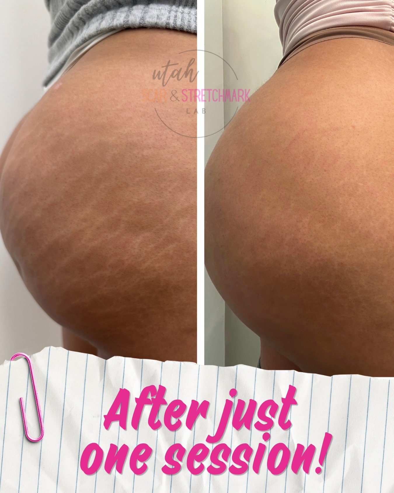 Very happy client after just one session!  A few of the stretch marks are still a little bit red. She is almost healed and ready for her next session. 🤎