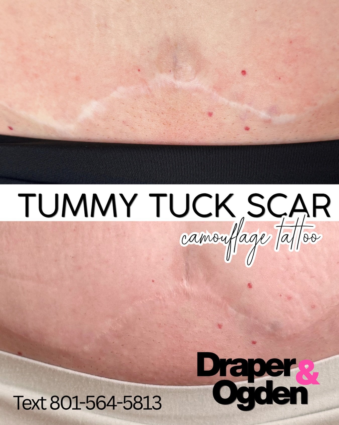 Hey Utah!  My name is Meagan Chapman.  I'm a medical tattoo specialist and I can help you with your scars and stretch marks 🤎

✅Tummy Tuck Scars
✅Breast Lift Scar
✅Facelift Scars
✅Post pregnancy stretch marks
✅Burn Scars

I have two offices located 