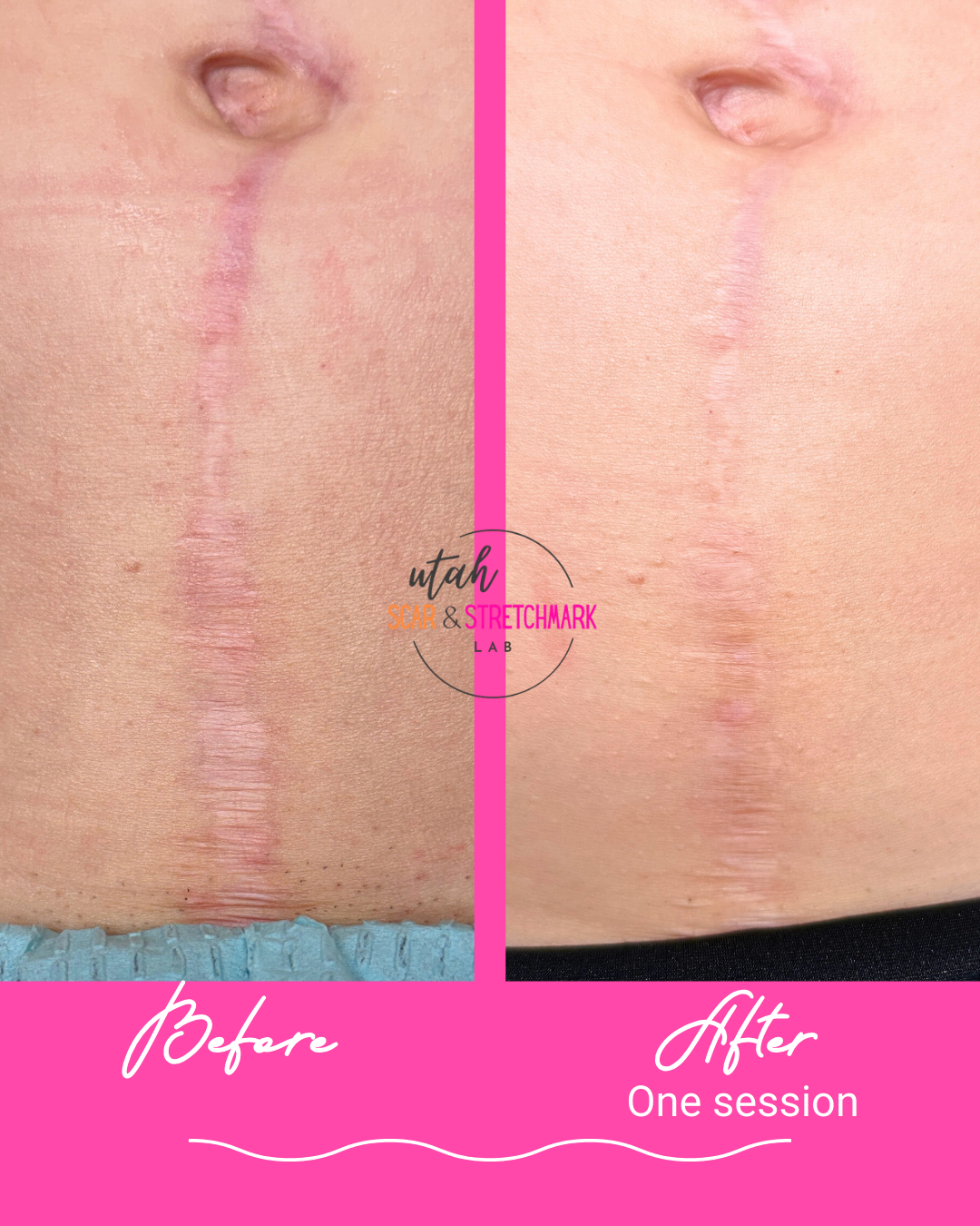 surgical scar treatment before after