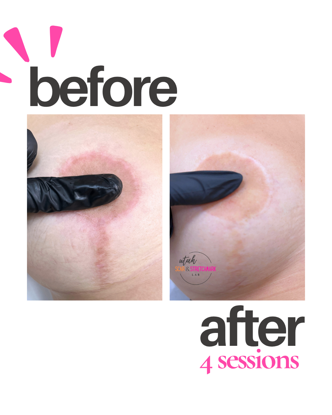 breast lift scar tattoo before after ogden utah