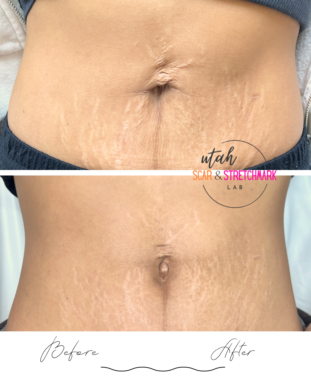 Copy of Neutral Minimalist Skincare Before and After Instagram Post.png