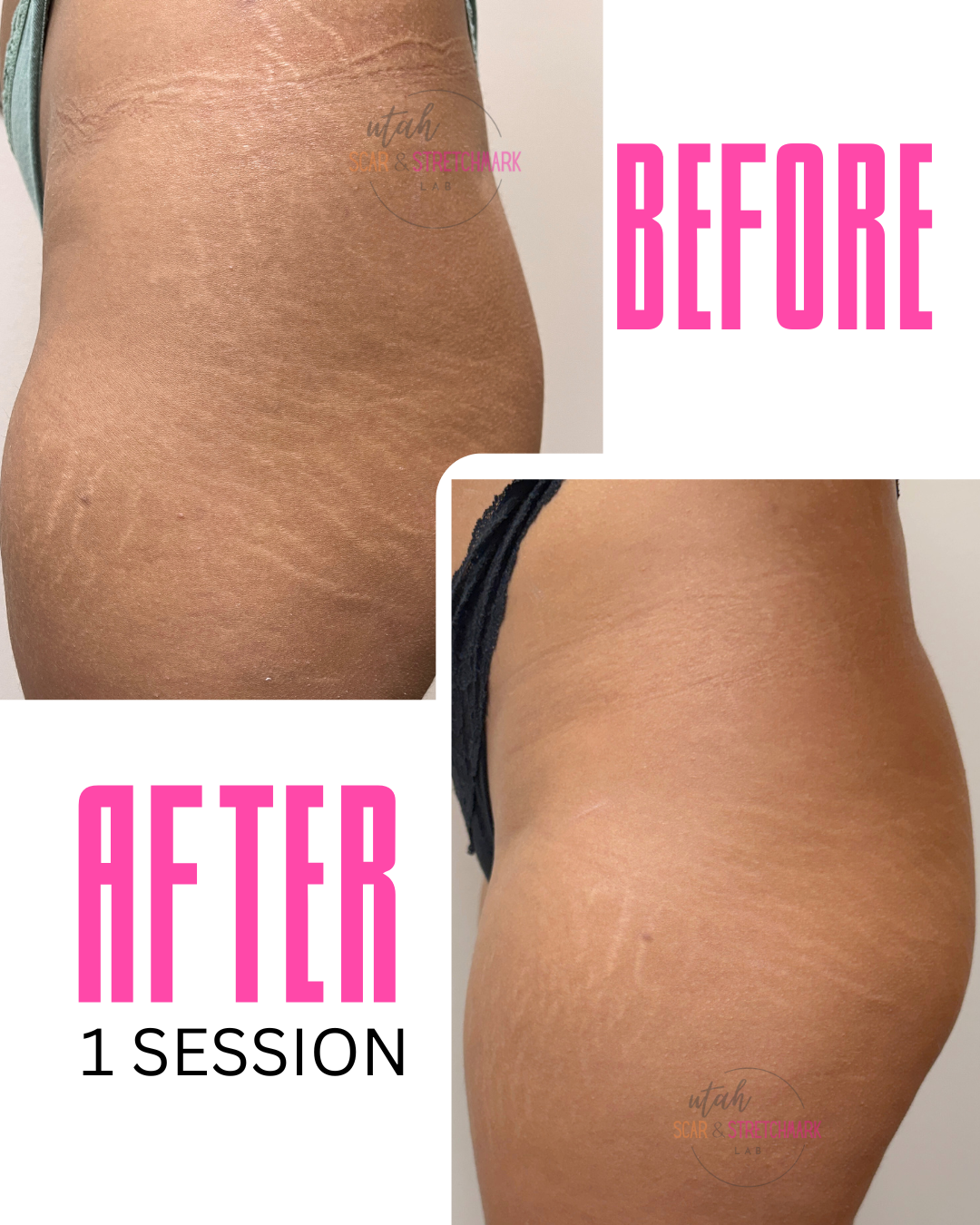 stretch mark treatment before after paramedical tattoo inkless 