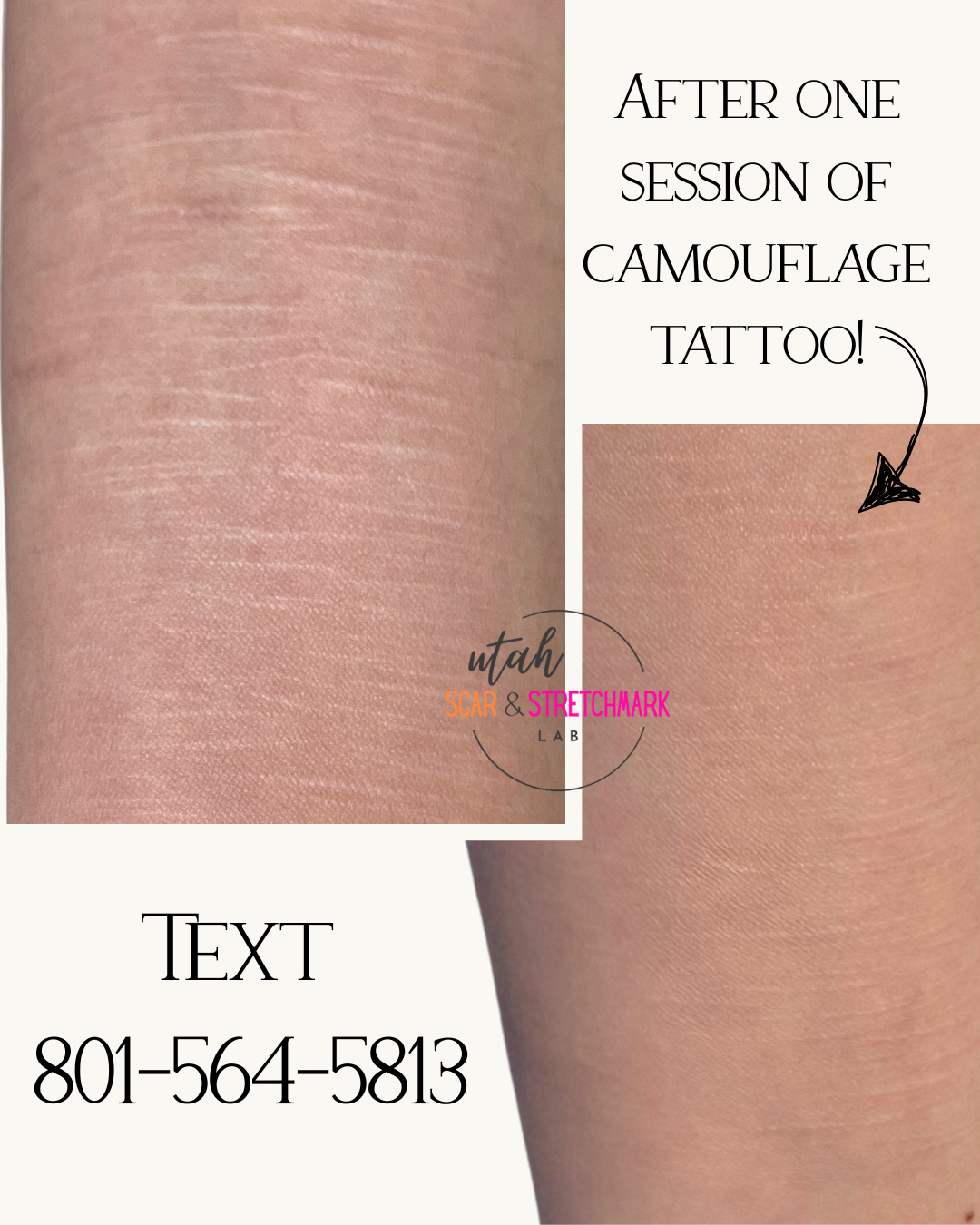self harm scar treatment near me ogden utah before and after camouflage tattoo