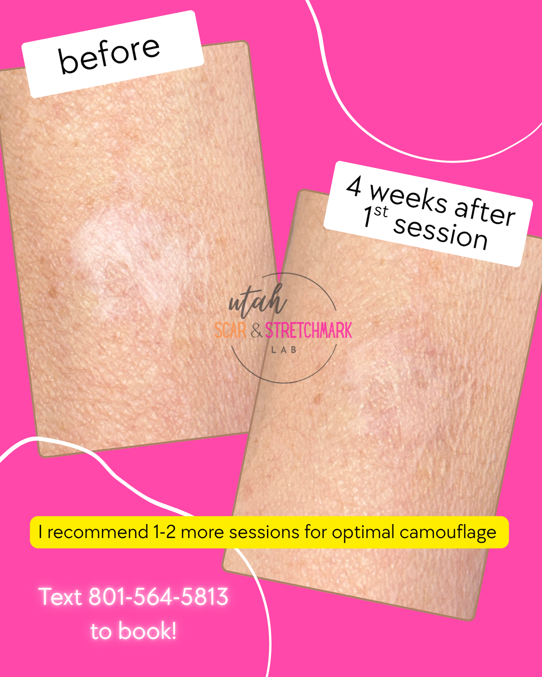 burn scar tattoo cover up before after utah