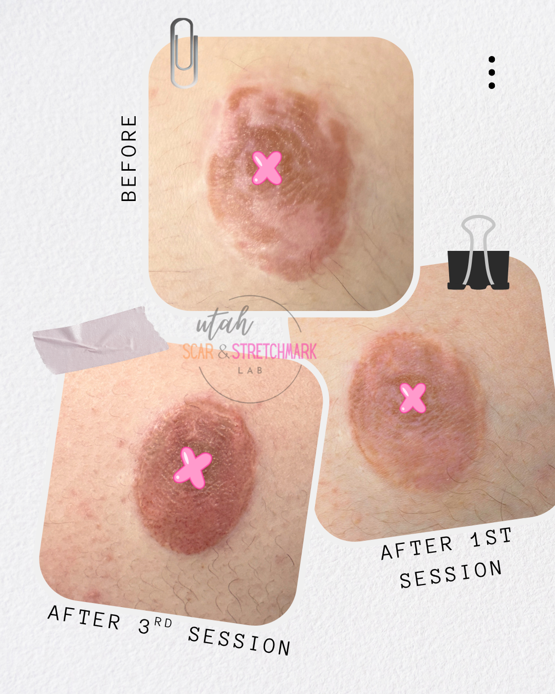 breast lift scar removal utah
