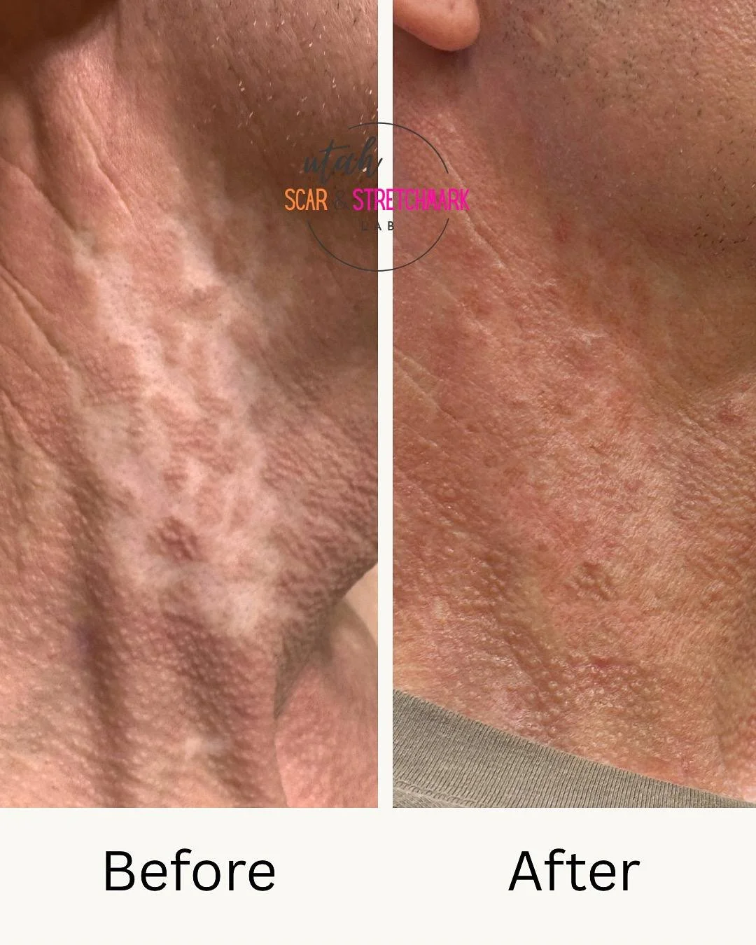 Laser burn hypopigmentation fixed with camouflage tattoo.