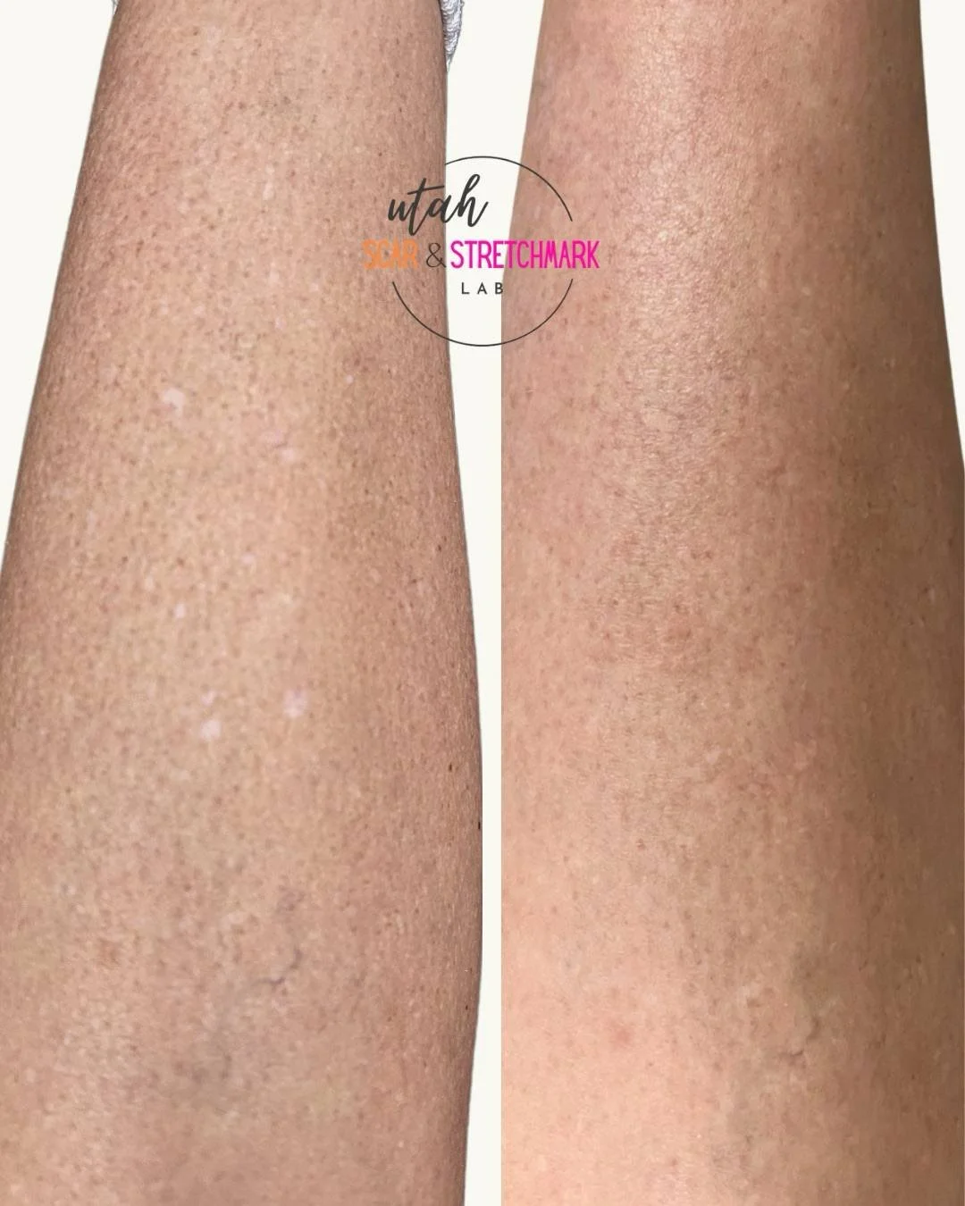 hypopigmentation scars fixed with camouflage tattoo utah