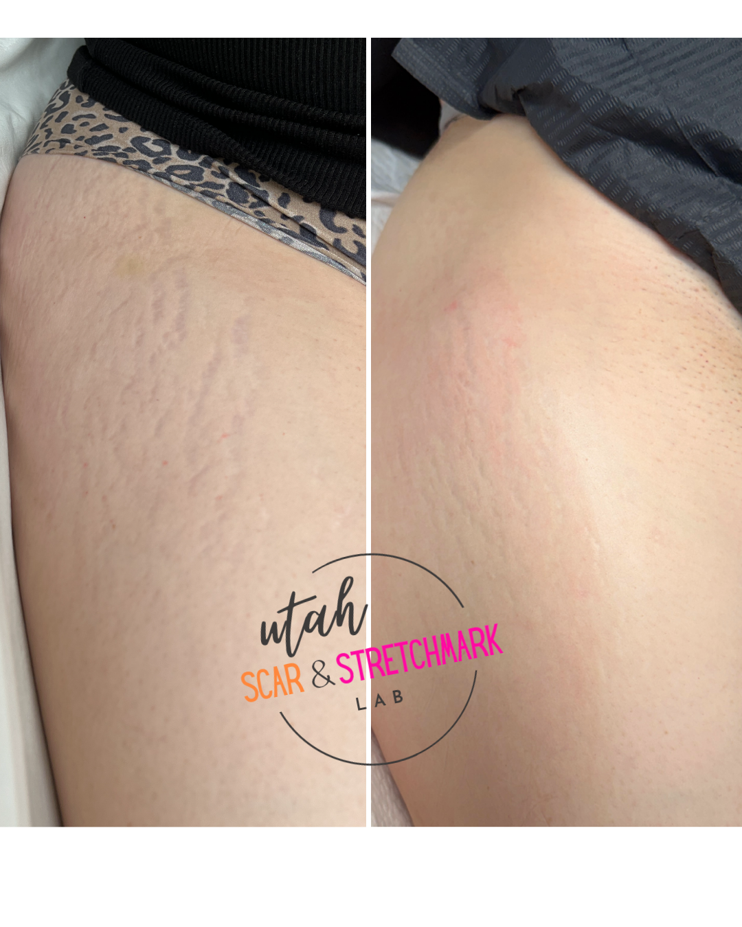Thigh stretch mark treatment before after paramedical tattoo inkless tattoo
