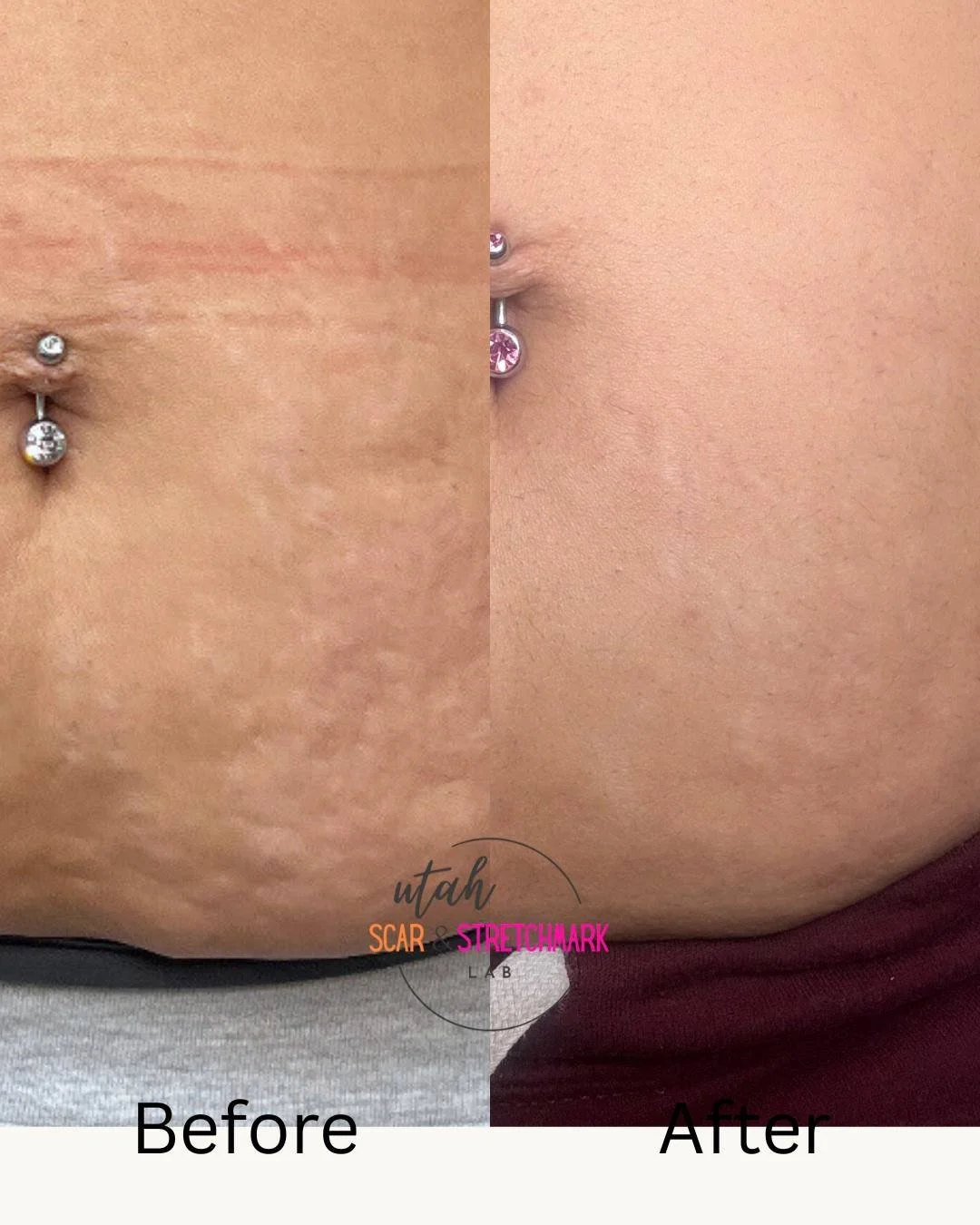 Side-by-side comparison of a person's abdomen showing a stretch mark before and after treatment. The 'Before' side has visible, slightly indented scars, while the 'After' side shows smoother skin with less visible stretch marks.
