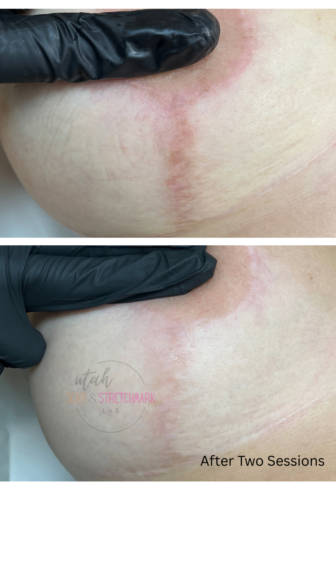 Breast lift scar treatment Ogden, Utah