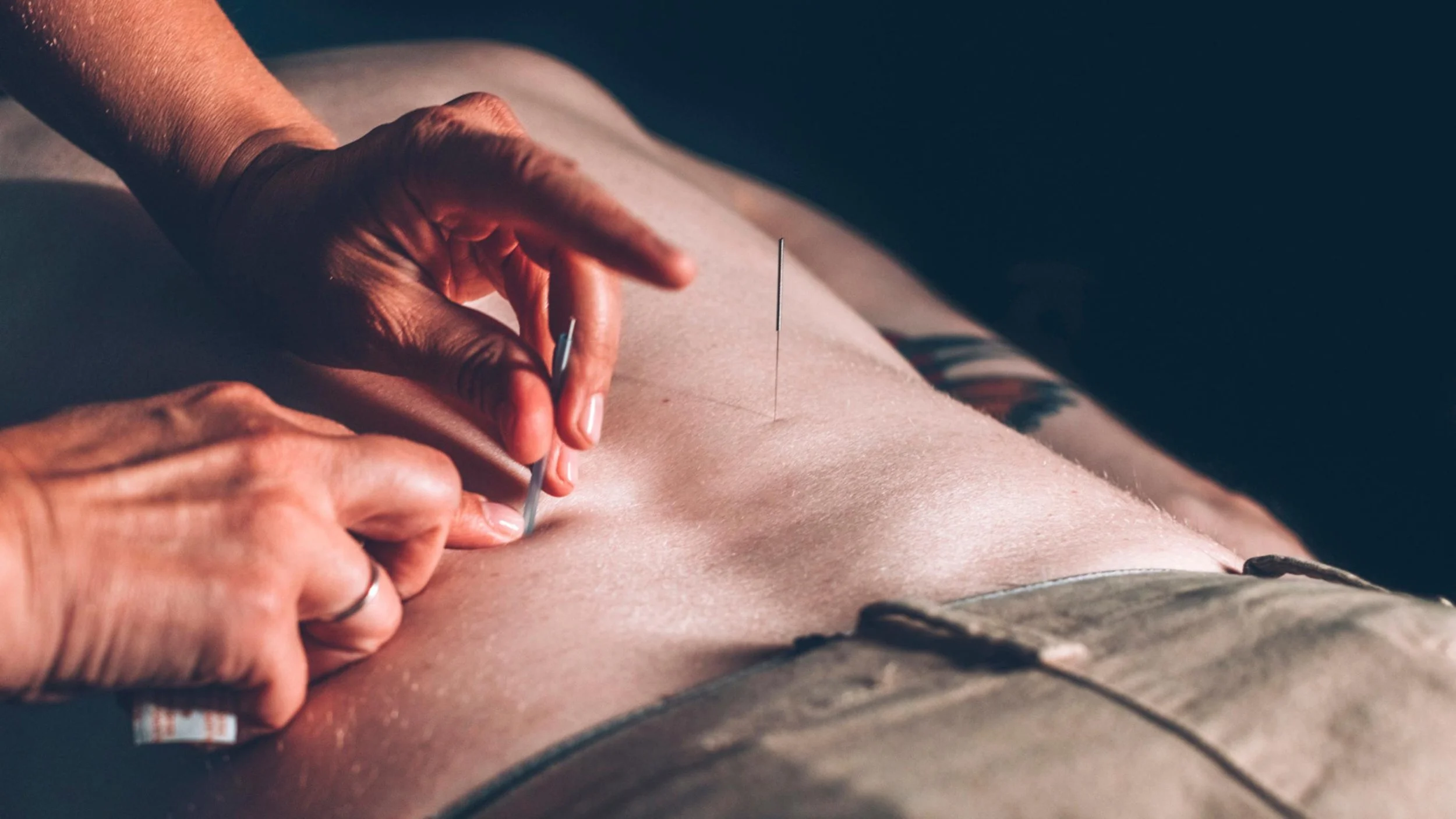 Close-up of an acupuncturist placing needles into a male patient's back.