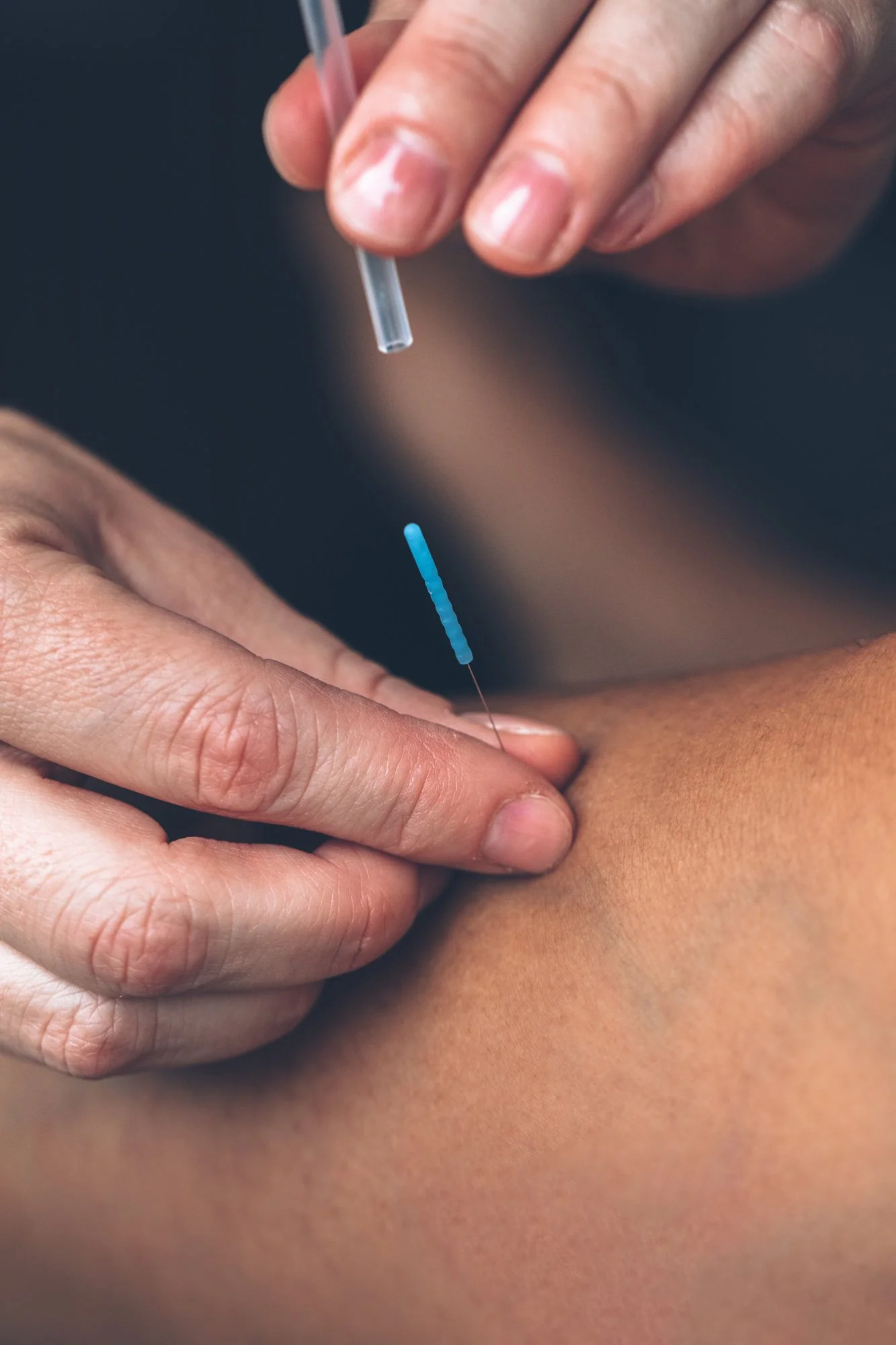 Close-up of a medical professional administering acupuncture to a person's skin using a thin needle.