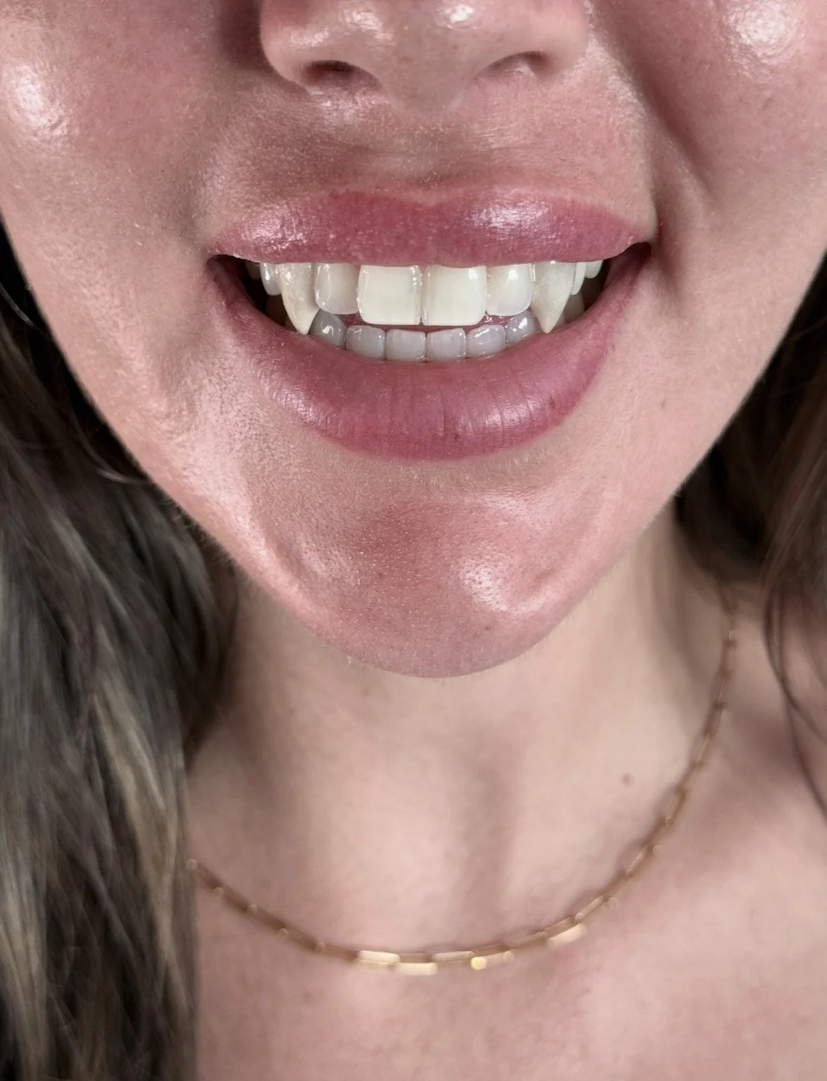 Close-up of a smiling woman's mouth showing teeth, with some visible brass braces on the lower teeth.