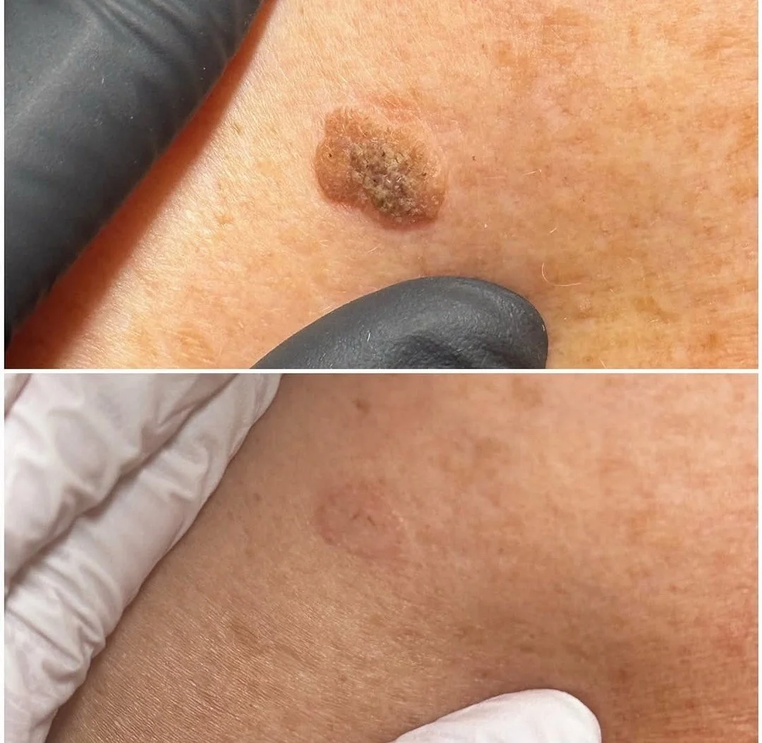 🐆Rolling SIIT Pro back to my intro price $175 (reg.$275) for the hour or $25 (reg. $50) per spot for Black Friday! Sebaceous hyperplasia (those tiny, soft, raised bumps that come from overactive oil glands) are totally normal&hellip; but if you&rsqu