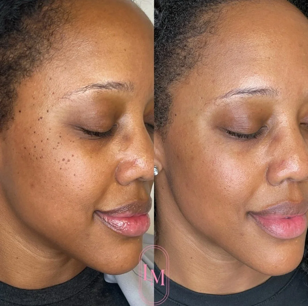 Ever wonder what those tiny, raised dark bumps are that show up mostly on brown skin and multiply like cousins at a family reunion? 

🌿 They&rsquo;re called 𝗗𝗲𝗿𝗺𝗮𝘁𝗼𝘀𝗶𝘀 𝗣𝗮𝗽𝘂𝗹𝗼𝘀𝗮 𝗡𝗶𝗴𝗿𝗮 &mdash; little benign growths caused by exc