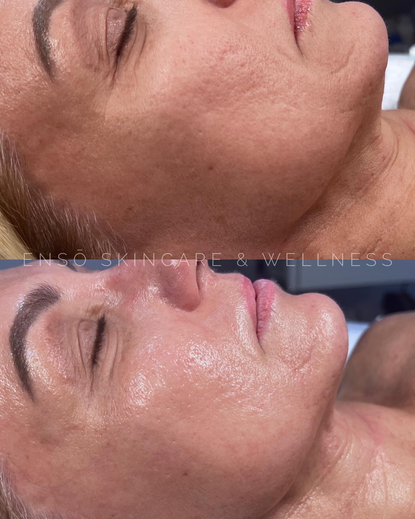 Before and after one DMK enzyme treatment.

Your skin is an intelligent ORGAN. The transfer messenger enzymes communicate with the cells of your skin to create homeostasis within the skin, to dilate the capillaries and induce increased blood flow of 
