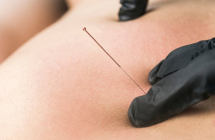 Gloved practitioner placing a fine dry needling needle into the muscle of a patient's back