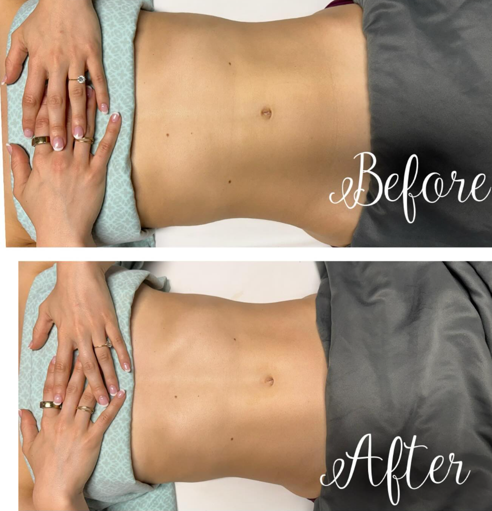 Brazilian Lymphatic Drainage Massage
