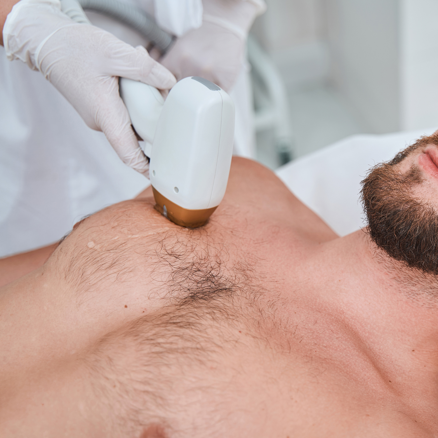 Epilation laser hommes