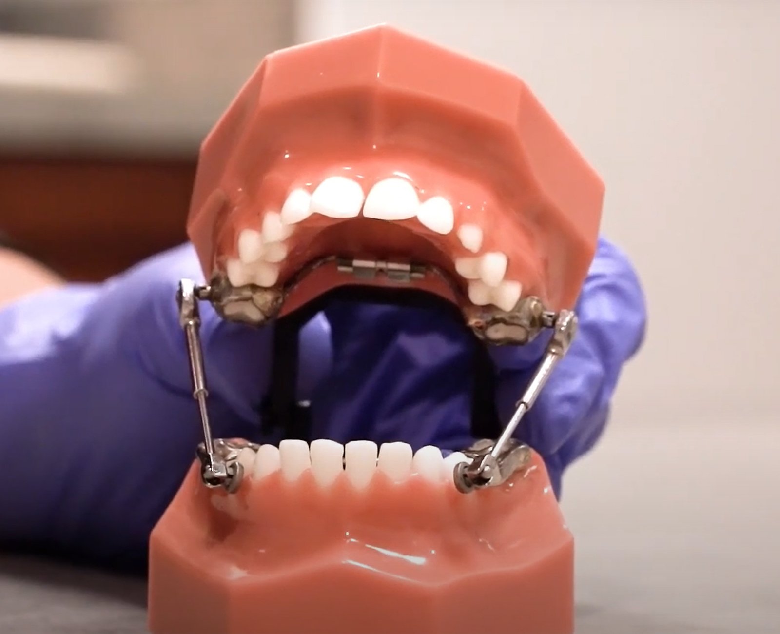 What is a Herbst Appliance and How Does It Work? — Cook Orthodontics of