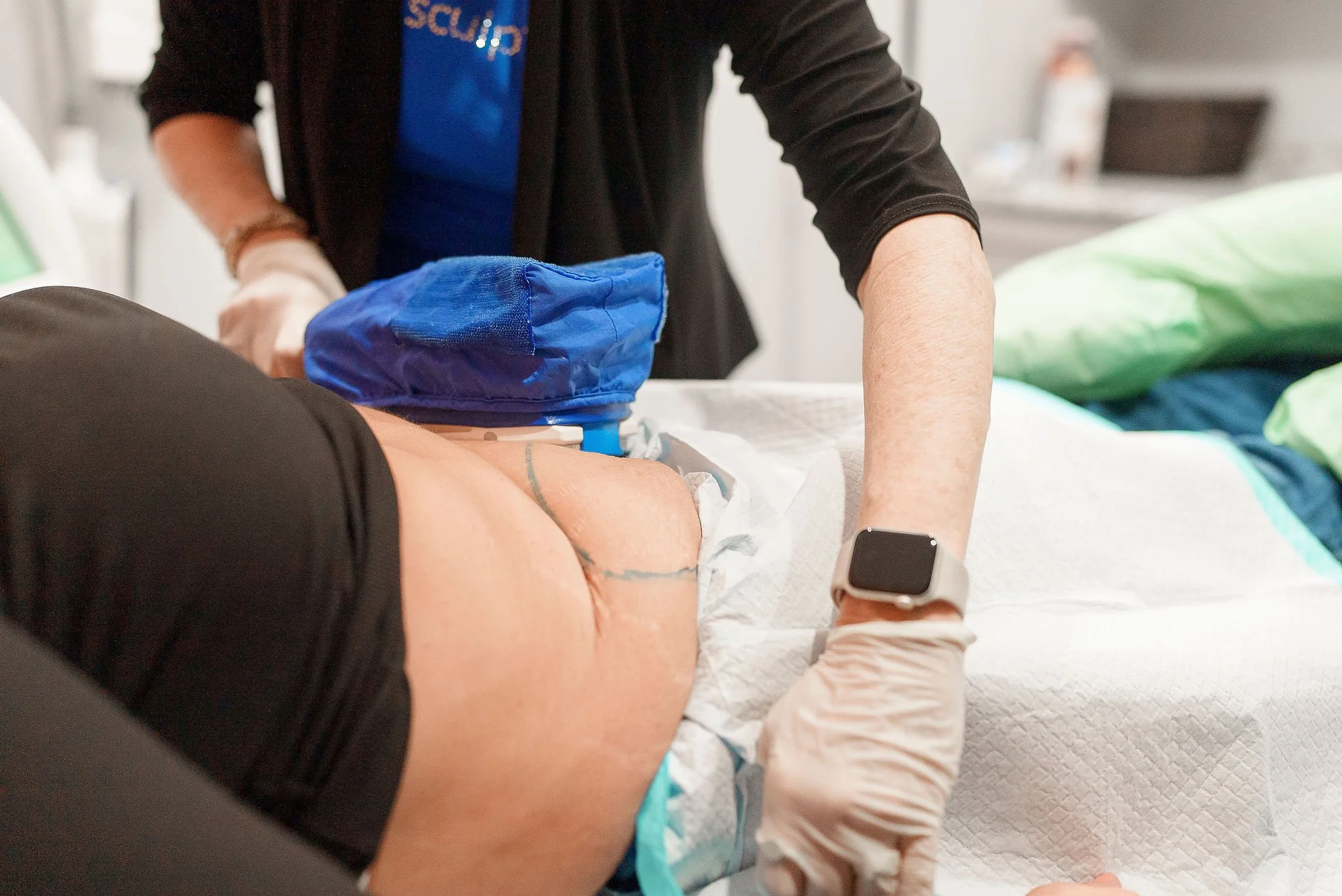 CoolSculpting in Chillicothe, Ohio: Reduce Belly Fat Without Surgery