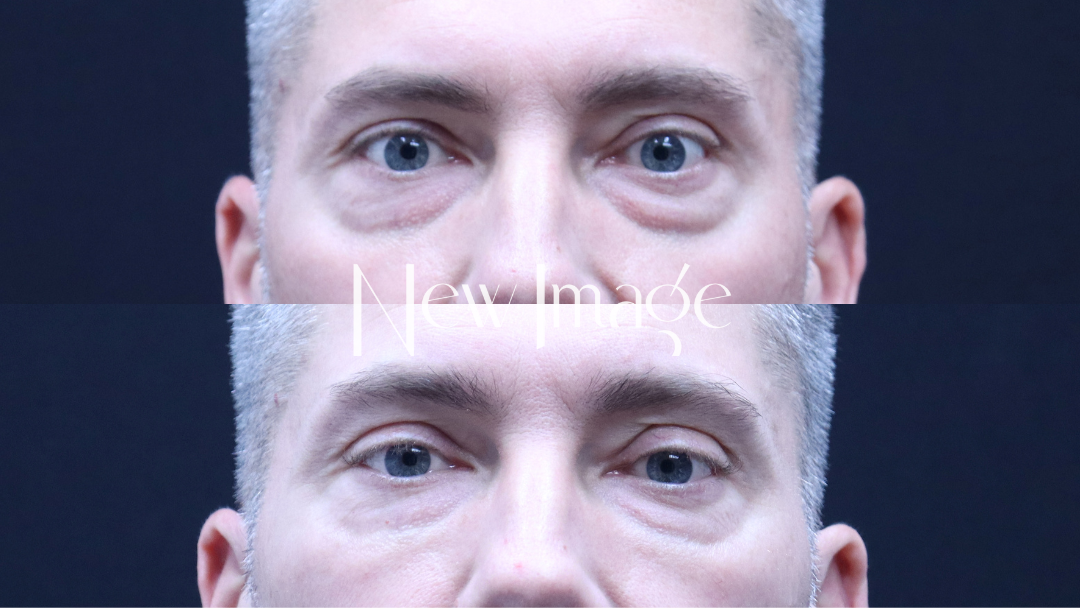 PRP for Undereyes: Is It Worth It?