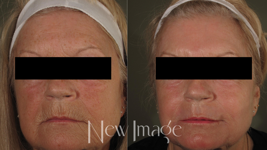 ProFractional Laser vs. CoolPeel CO2: What’s the Difference and Which Is Right for You?