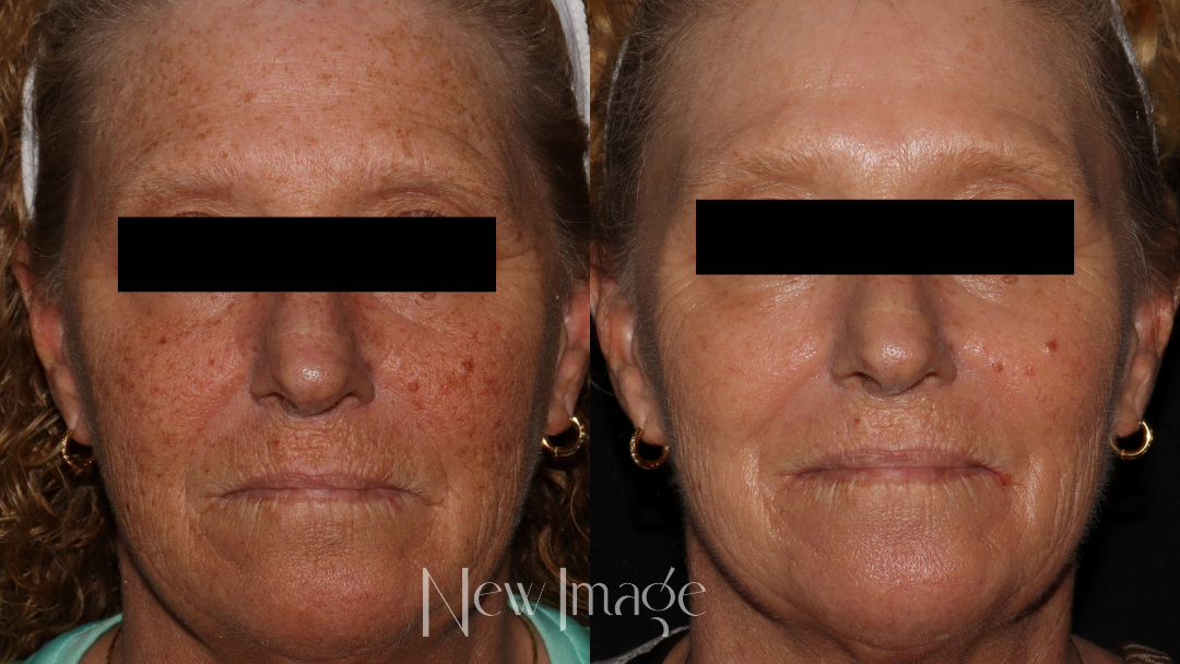 BBL Hero vs. Halo: Which Fall Treatment Is Right for You?