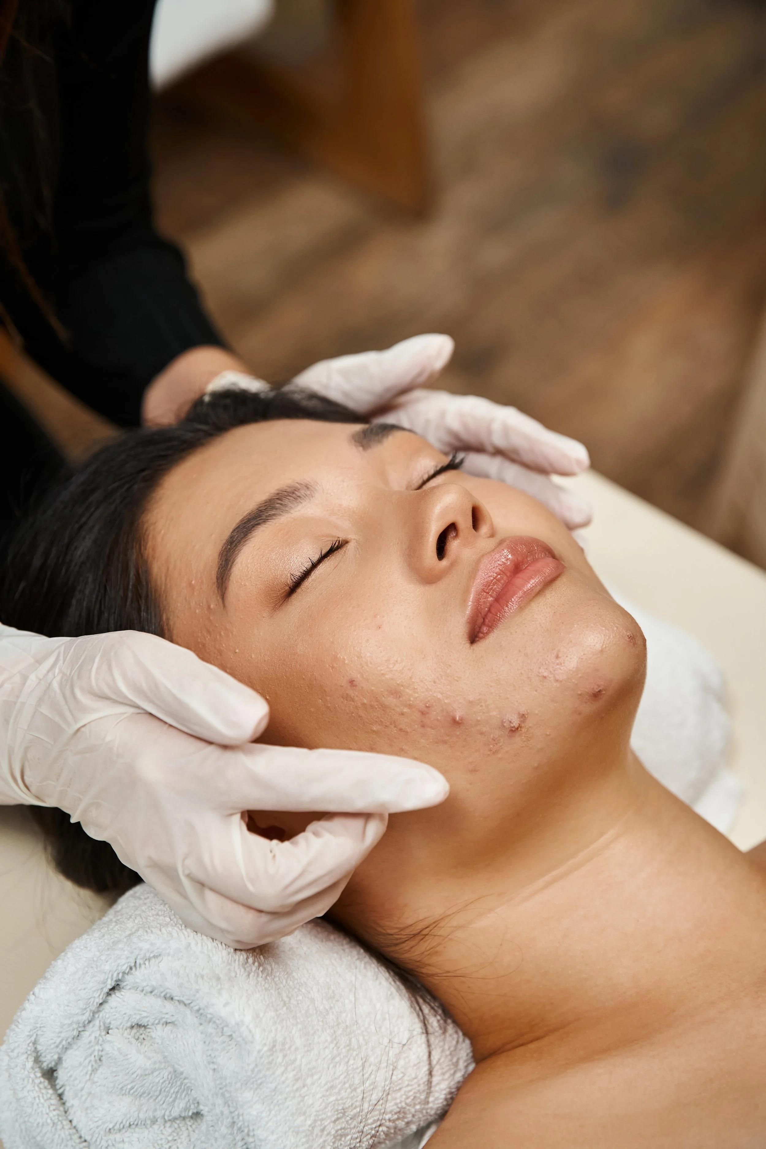 Navigating Your Skincare Journey at Zyone: Targeted Acne Treatment for Clearer Skin