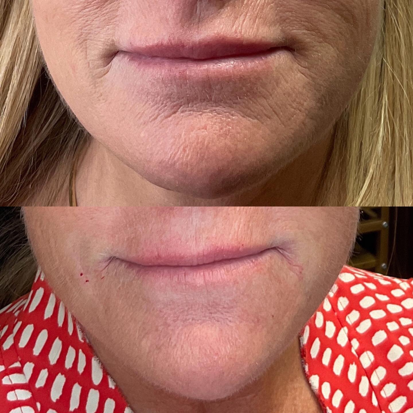 Beautiful and natural skin rejuvenation! 🥰

Only one syringe of Juvederm Ultra was used in the fine lines around her mouth and chin! 

All filler is 10% off for the month of July!

Call or text now to get scheduled! 515-802-1709