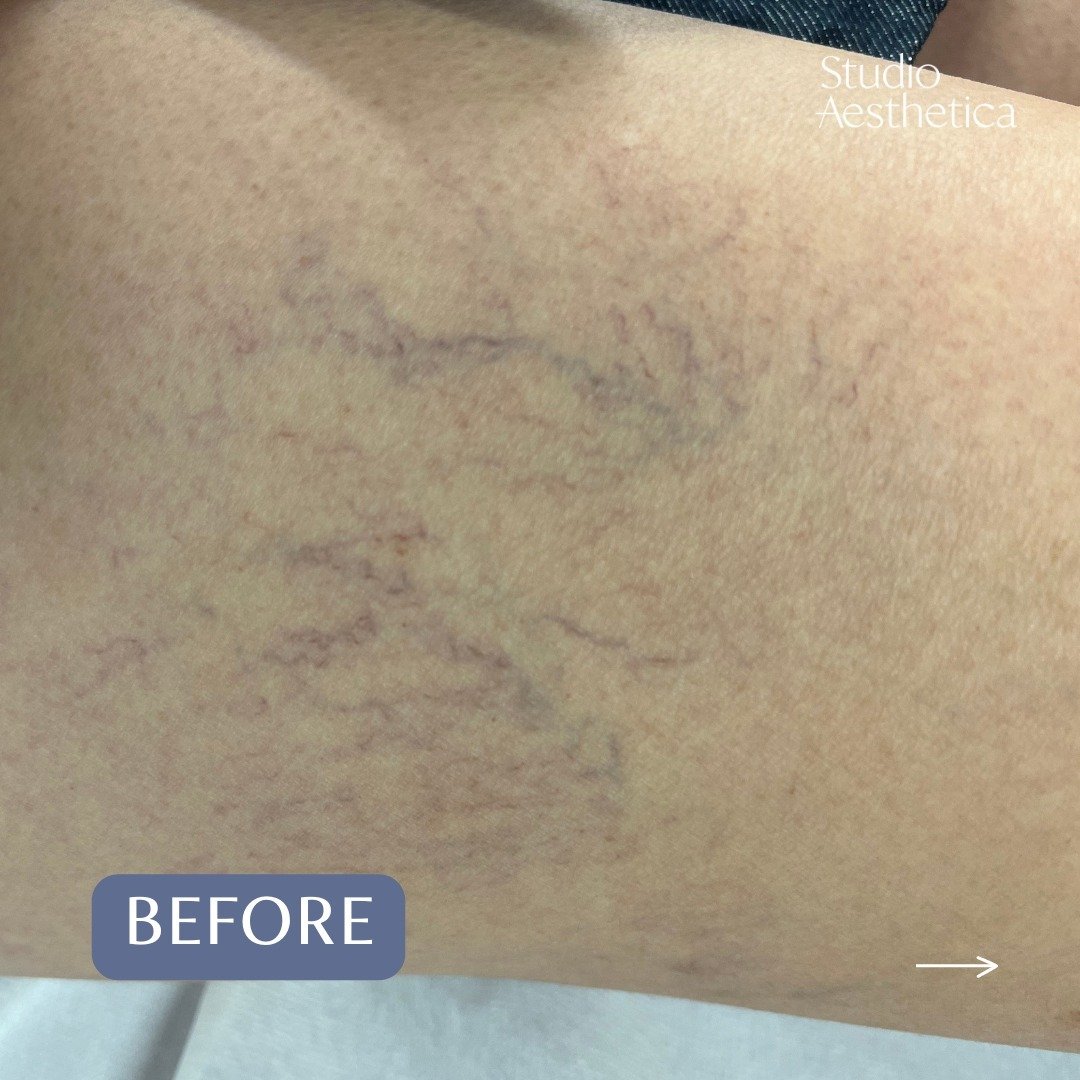 Take a look at our recent results treating spider leg veins with the Vascular and Pigmentation Excel V Laser.

Swipe left to see the transformation: from pre-treatment to one month post-treatment. 

Excel V's advanced technology targets blue, red, or