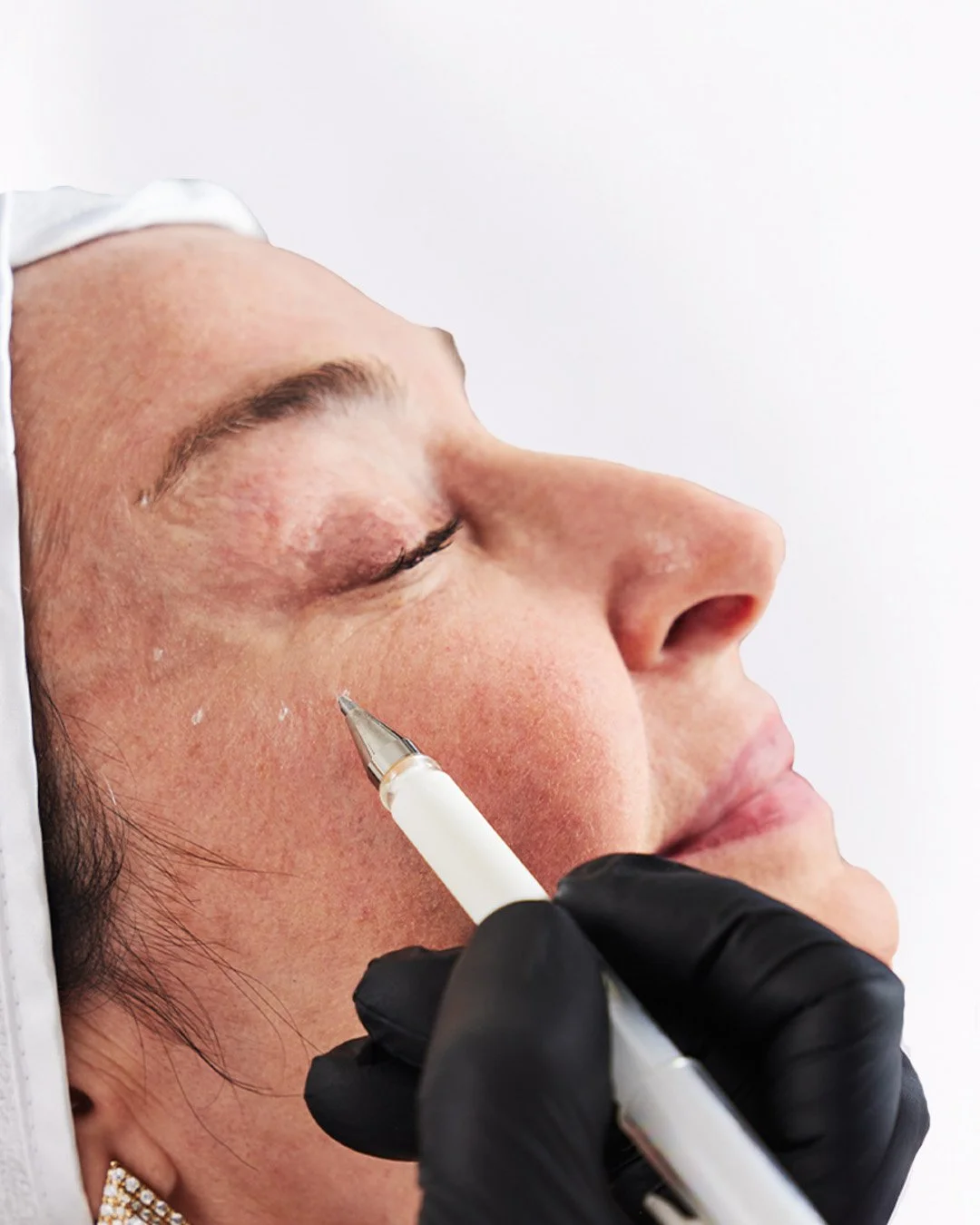 Skin quality treatments focus on improving overall skin quality rather than altering facial structure. 

It supports collagen and elastin production while delivering deep hydration to the skin, helping to strengthen the skin matrix, improve elasticit