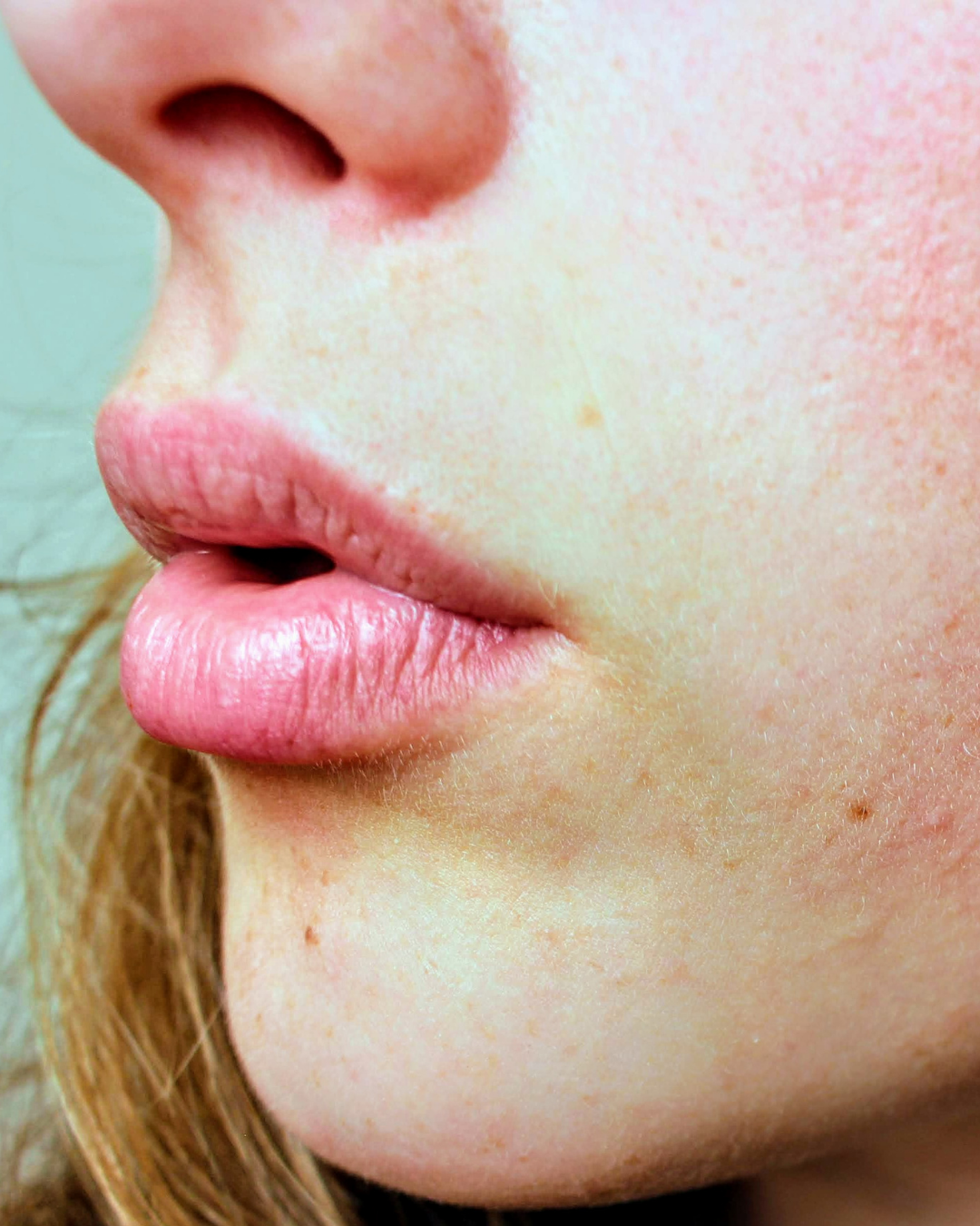 Rosacea Severity: The Role of Lipids, Gut Function, and Histamine