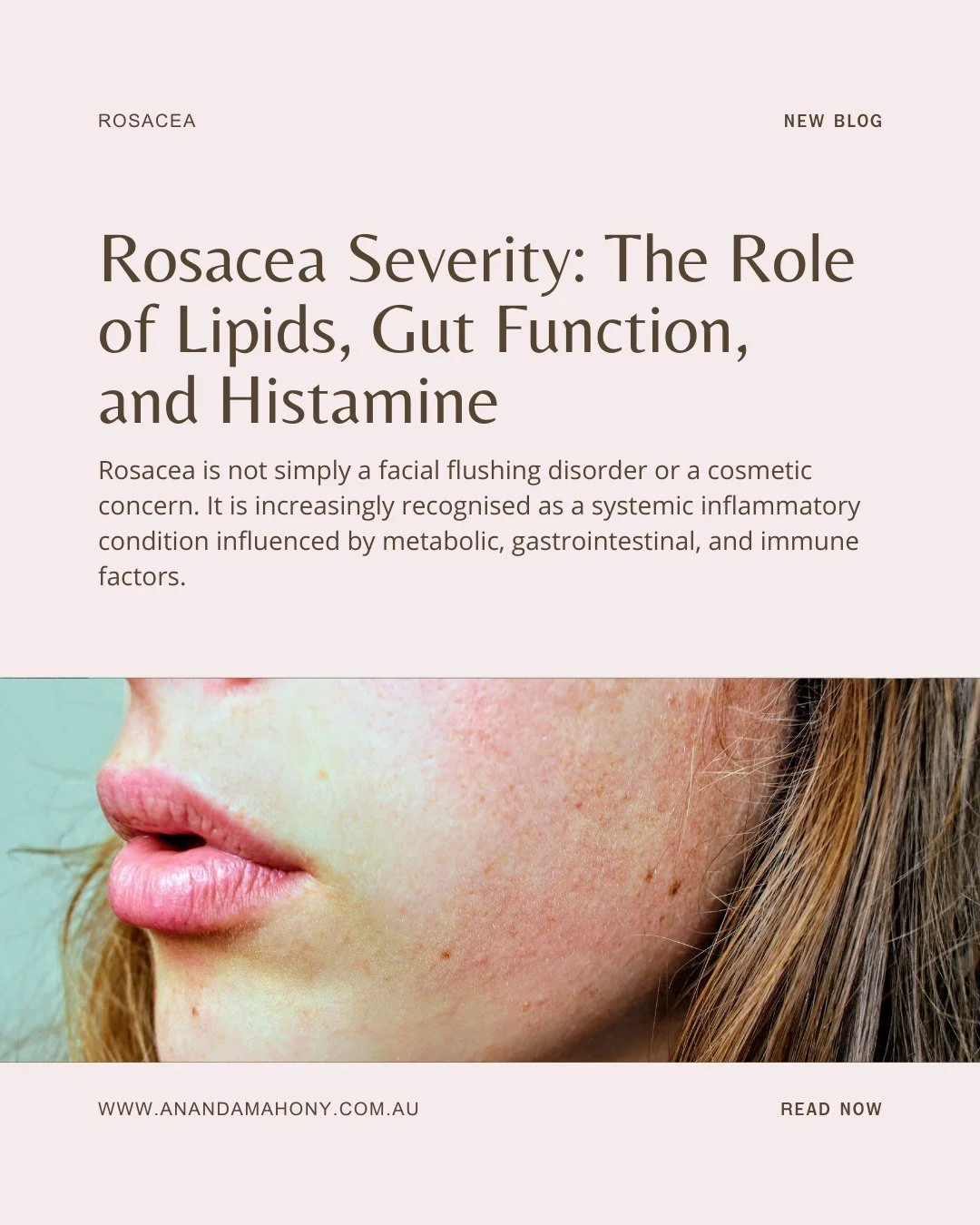 New Blog - Rosacea Severity: The Role of Lipids, Gut Function &amp; Histamine.

I know I bang on about this a lot but rosacea is more than a skin issue.

A 2026 disease severity analysis showed that rosacea clusters with systemic comorbidities, and s