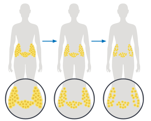 The Truth About Volume Reduction: How Cavitation and Laser Lipo Actually Work