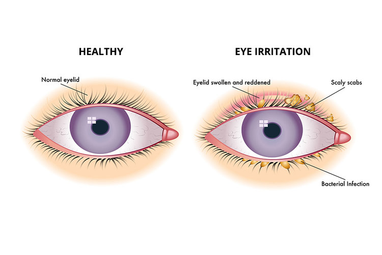 Dry Eye: Rosacea