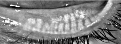 Meibomian gland after treatment. Optometry. Eye specialist. Eye treatments in vancouver.