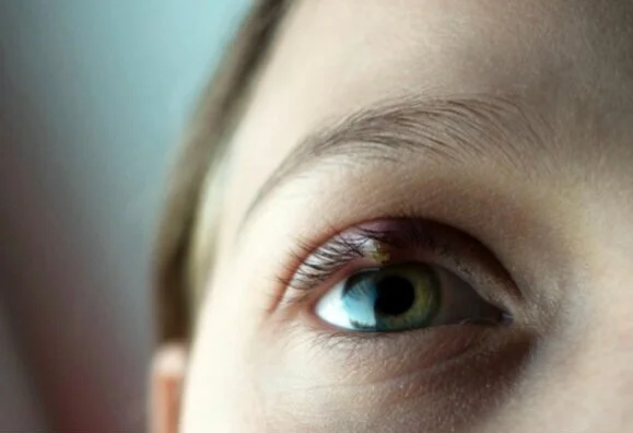 Dry Eye: Hordeolums (Styes)