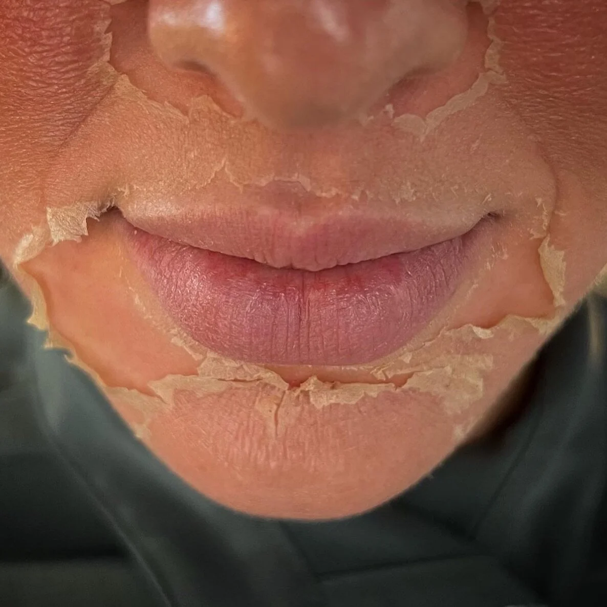ITS PEEL SEASON! Look at all that amazing skin under there! Make sure to book your series of 3 chemical peels with us to keep your skin looking great and to treat your sun damage through the winter!