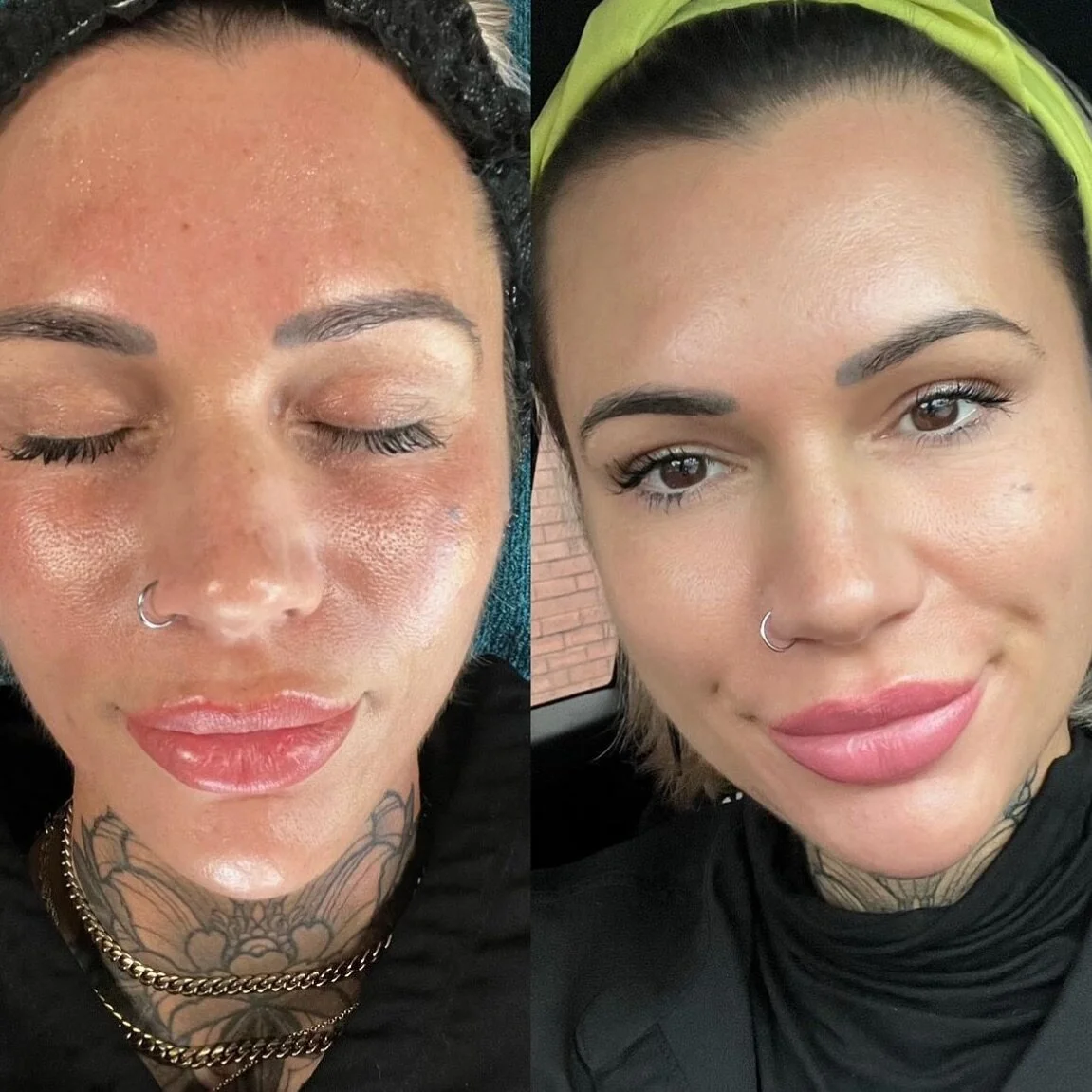 Right before and the morning after our Golden Glass Facial! There is NO face makeup on our patient in the second photo&mdash; WOW! A Glass Facial helps with rejuvenation and skin tightening of the face. This technique lifts and firms up the skin whil