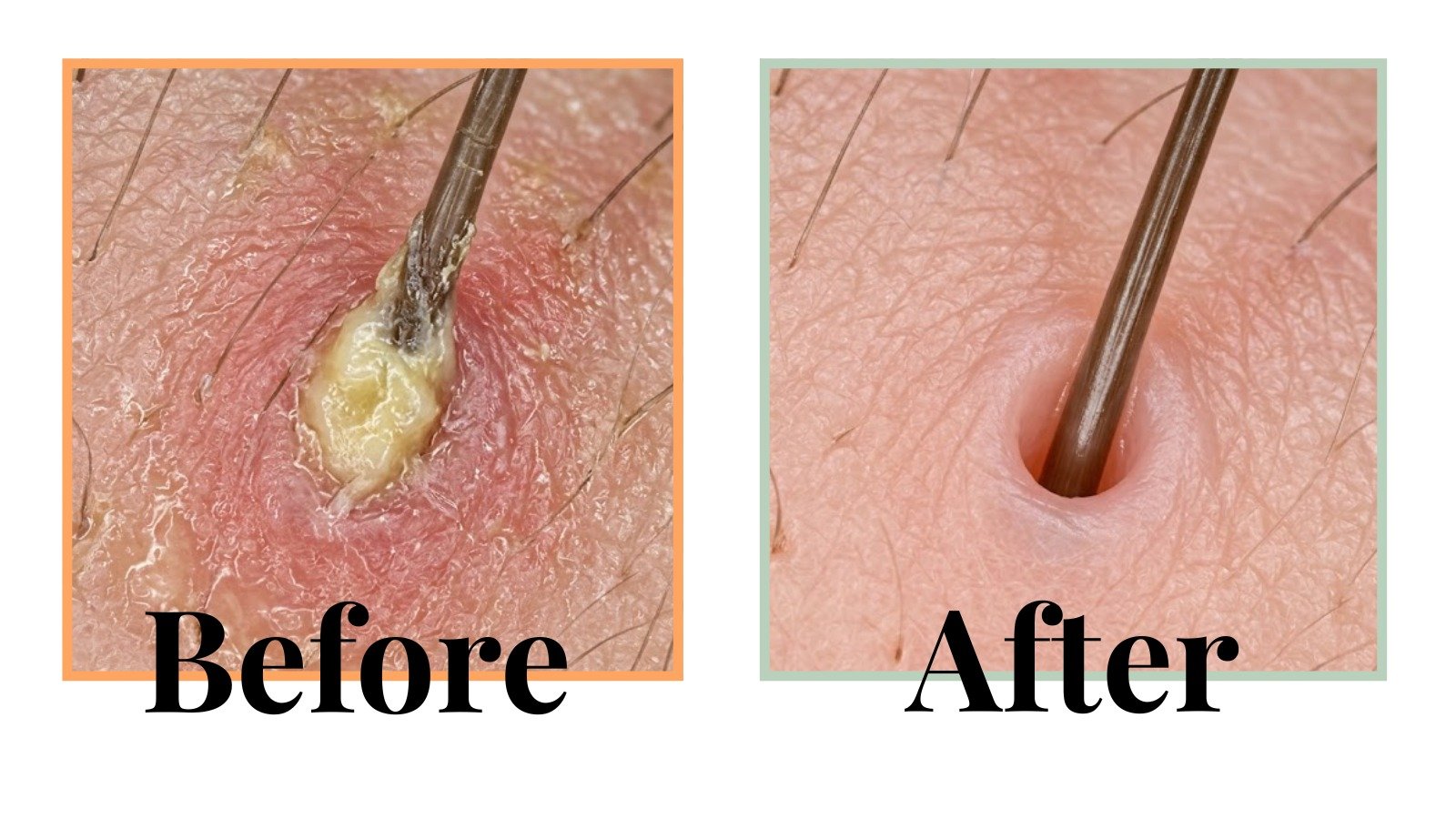 Microscopic before and after of a healthy scalp vs clogged hair follicles